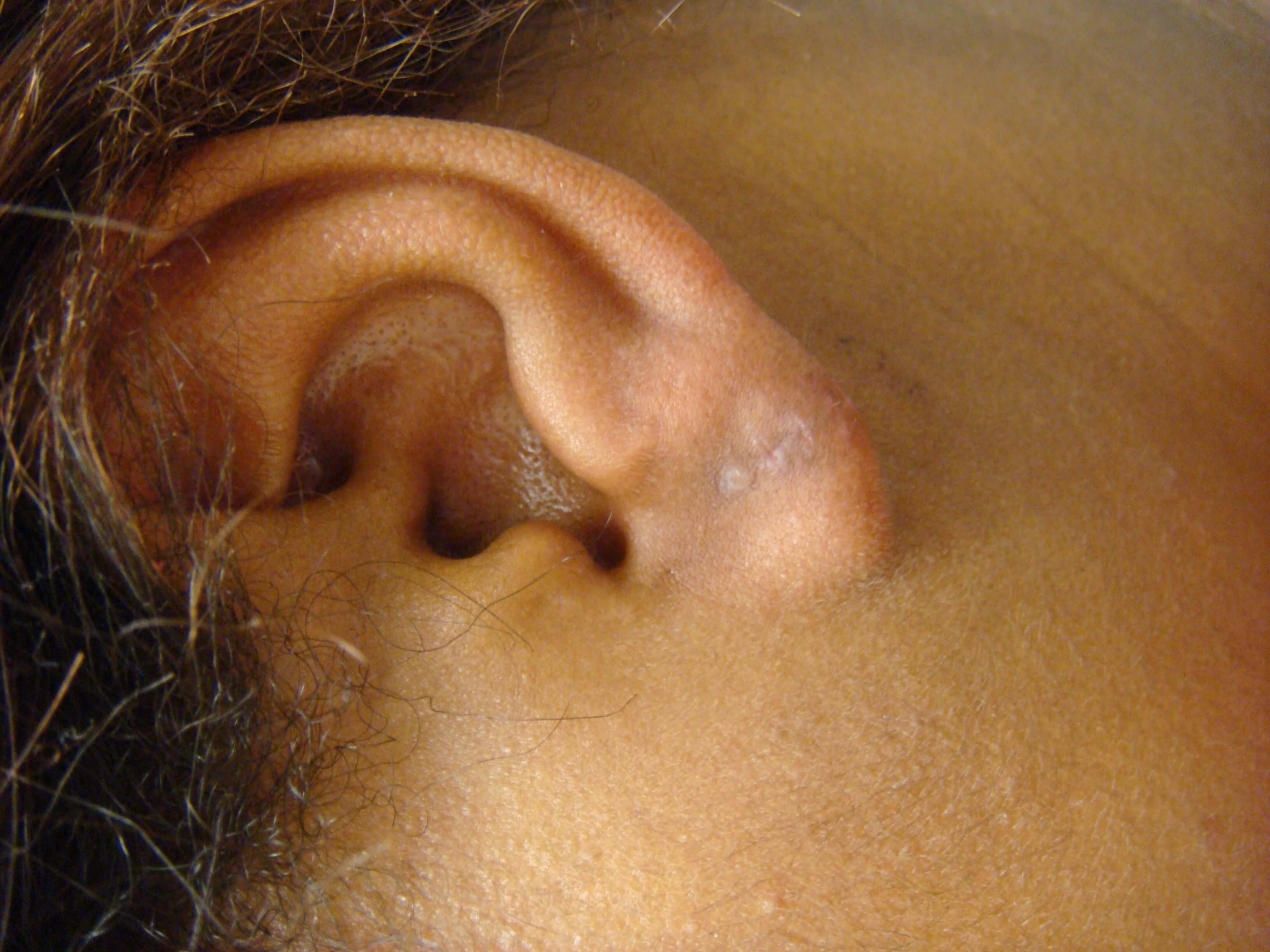 Earlobe Repair After