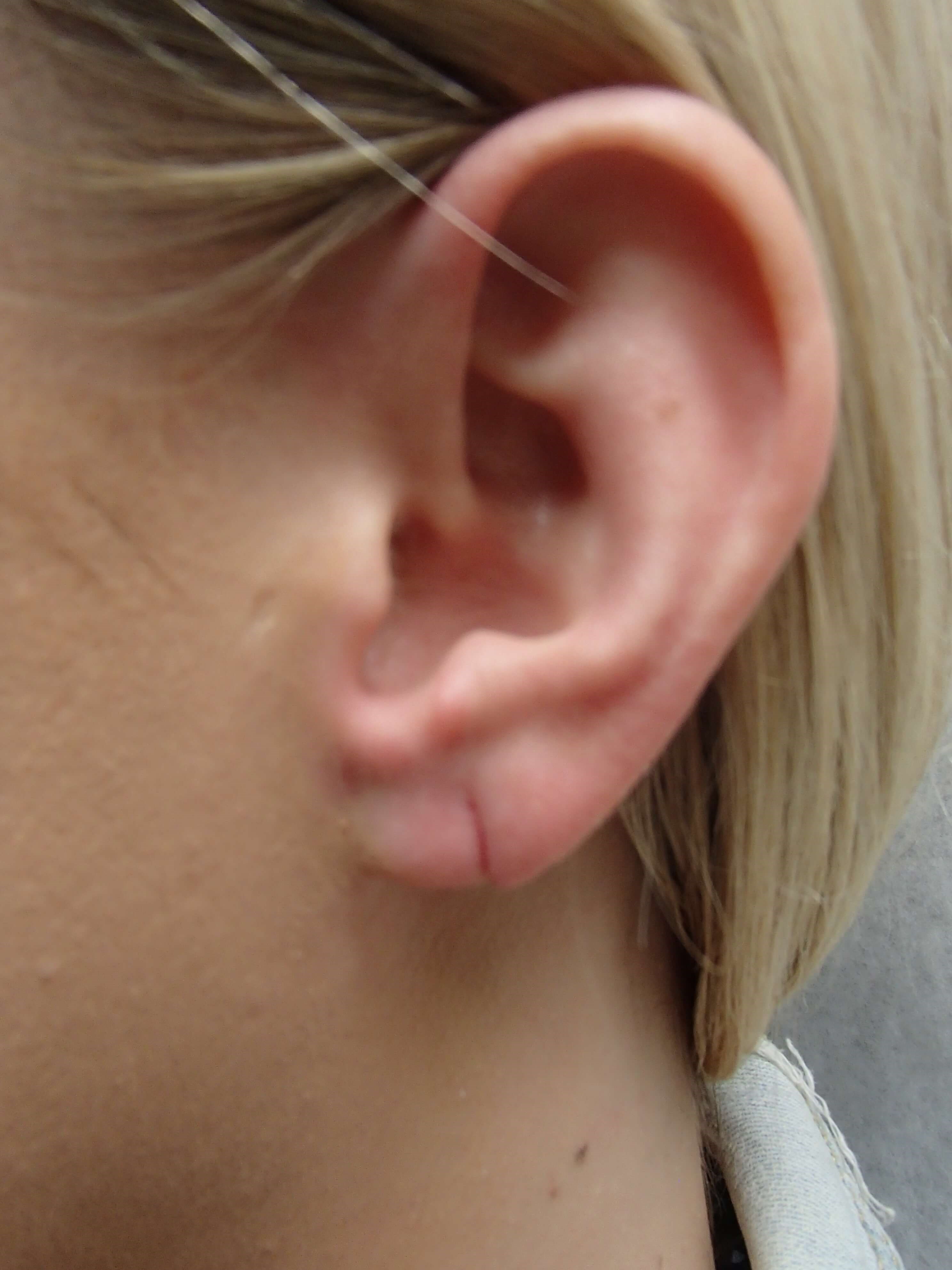 Earlobe Repair Before