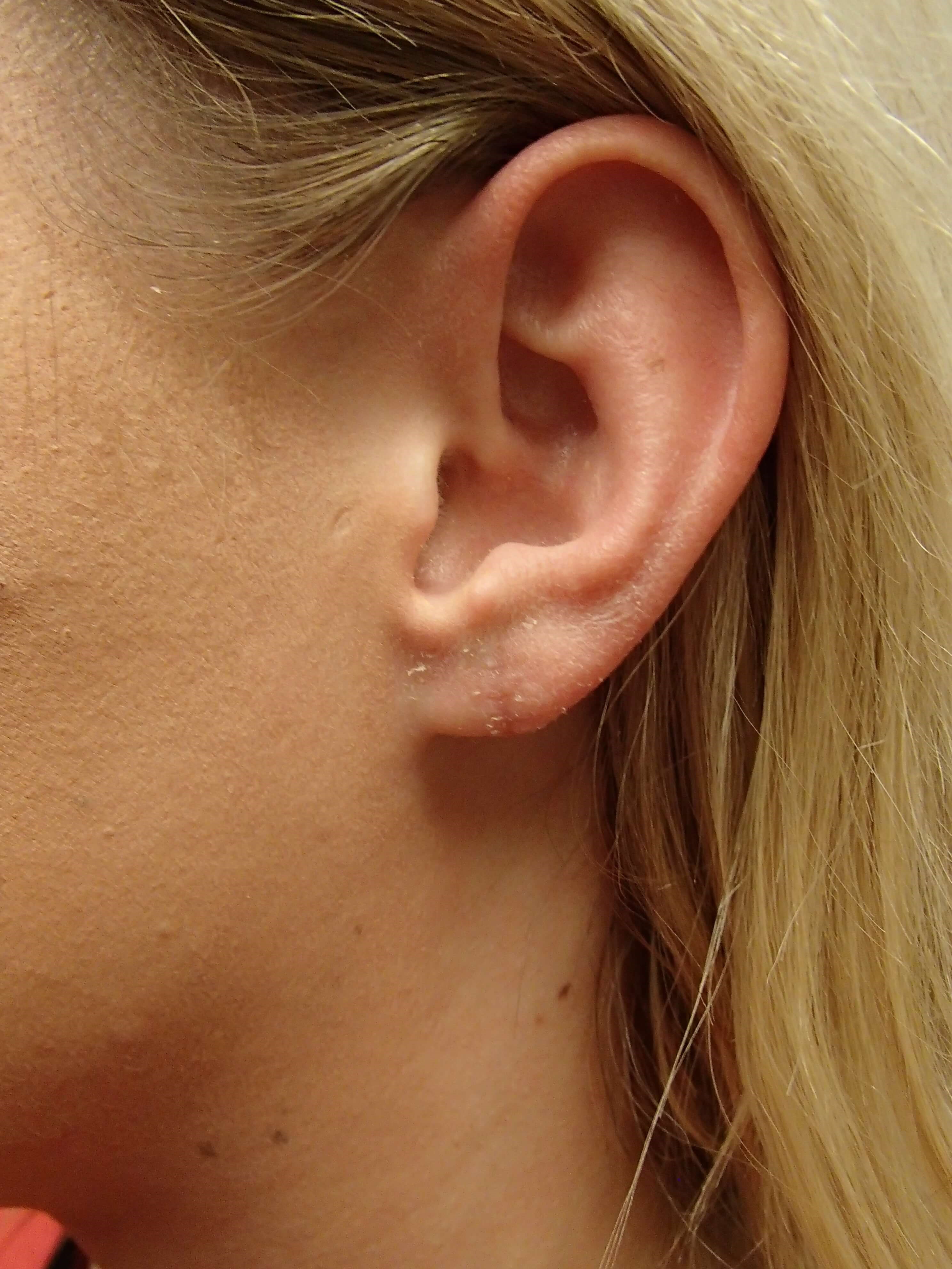 Earlobe Repair After