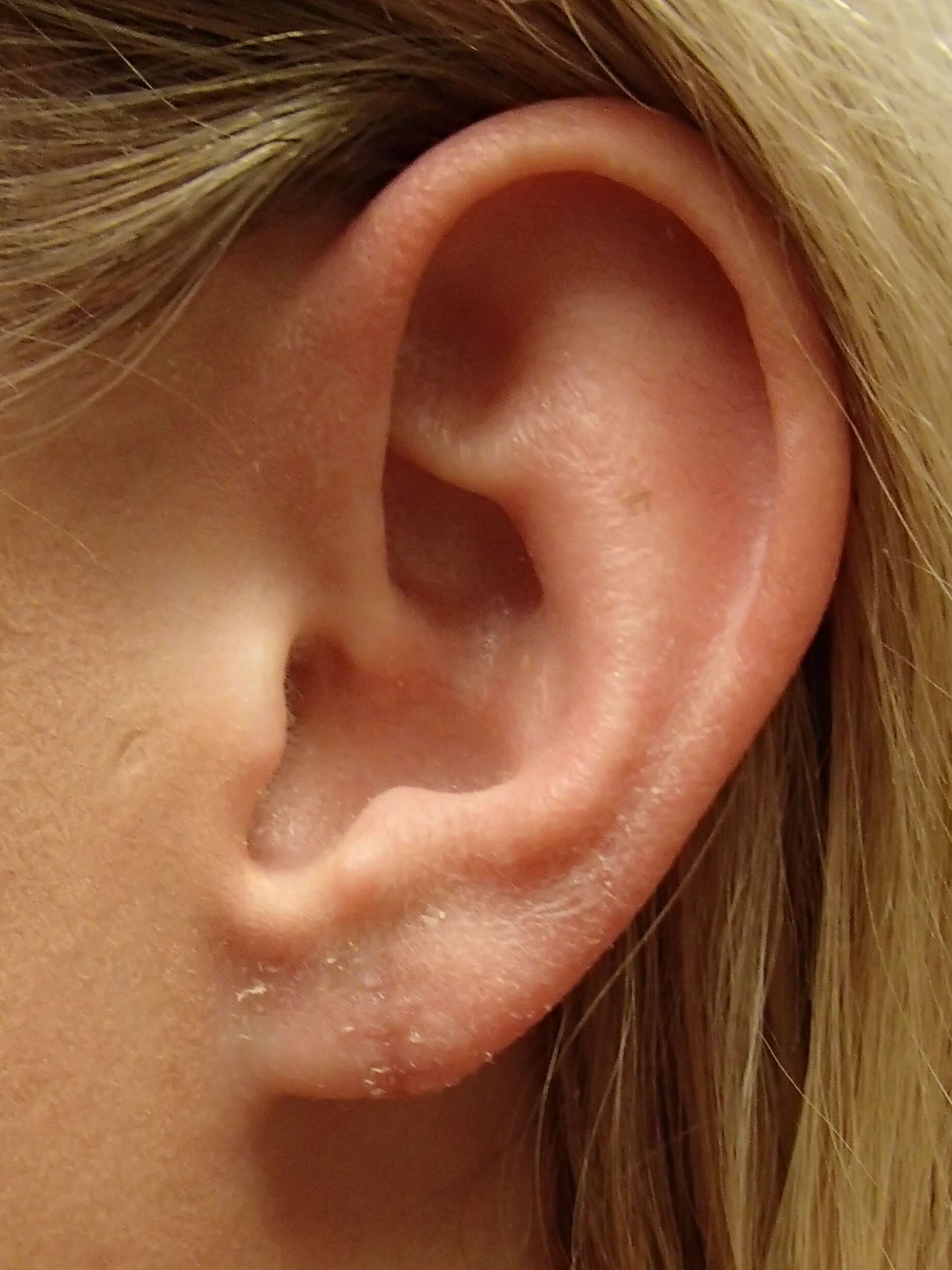Earlobe Repair After