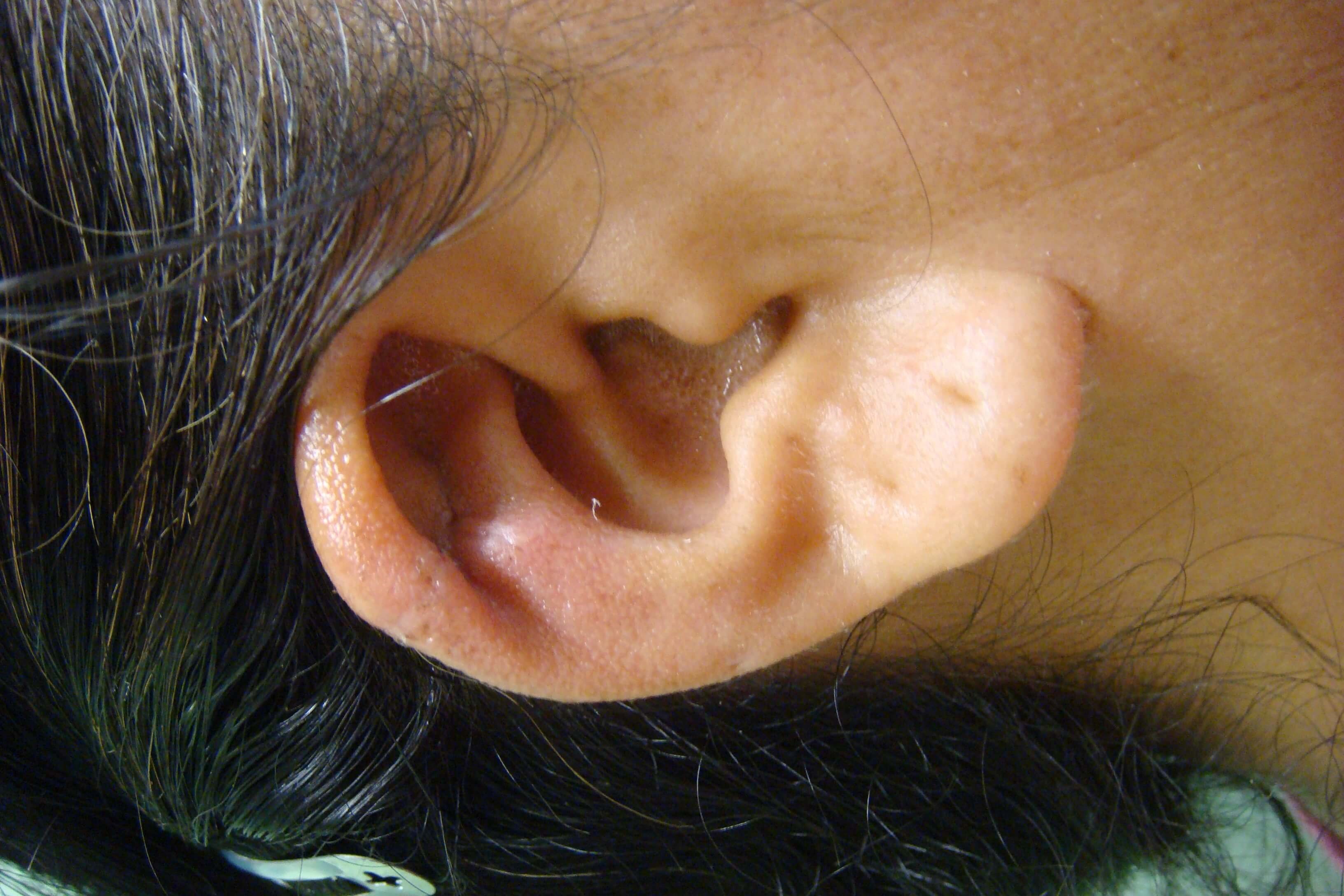 Ear Reconstruction - Keloid After