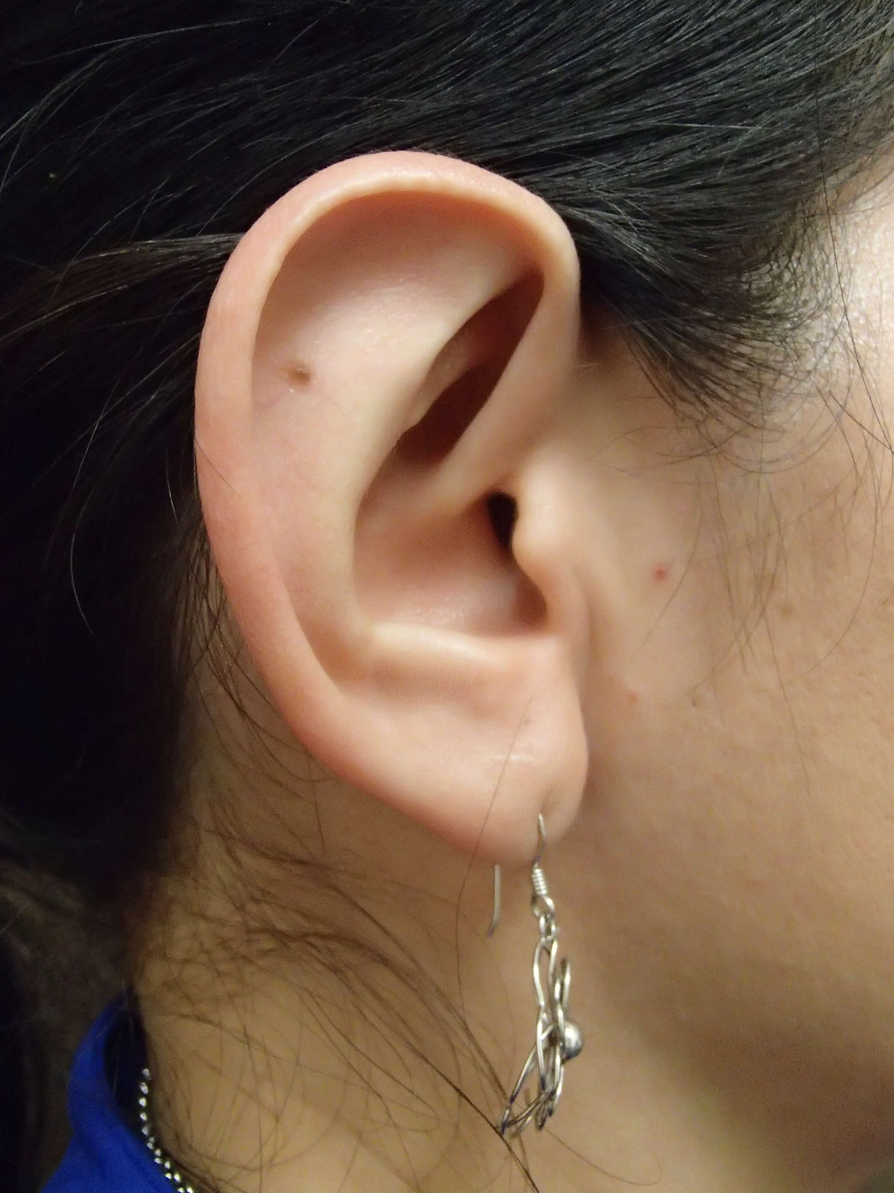 Otoplast - Ear Surgery After
