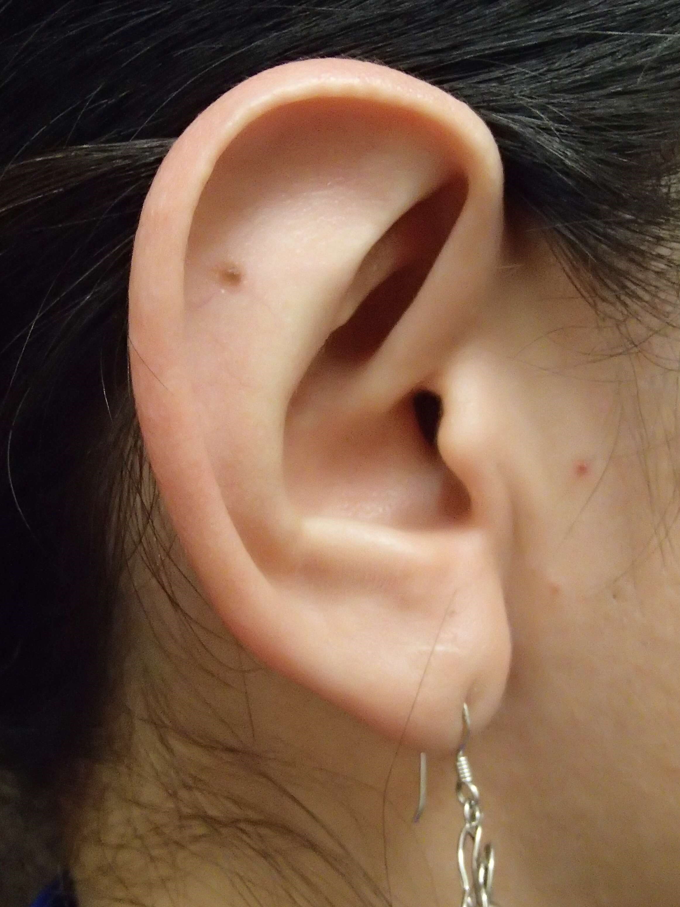 Otoplast - Ear Surgery After