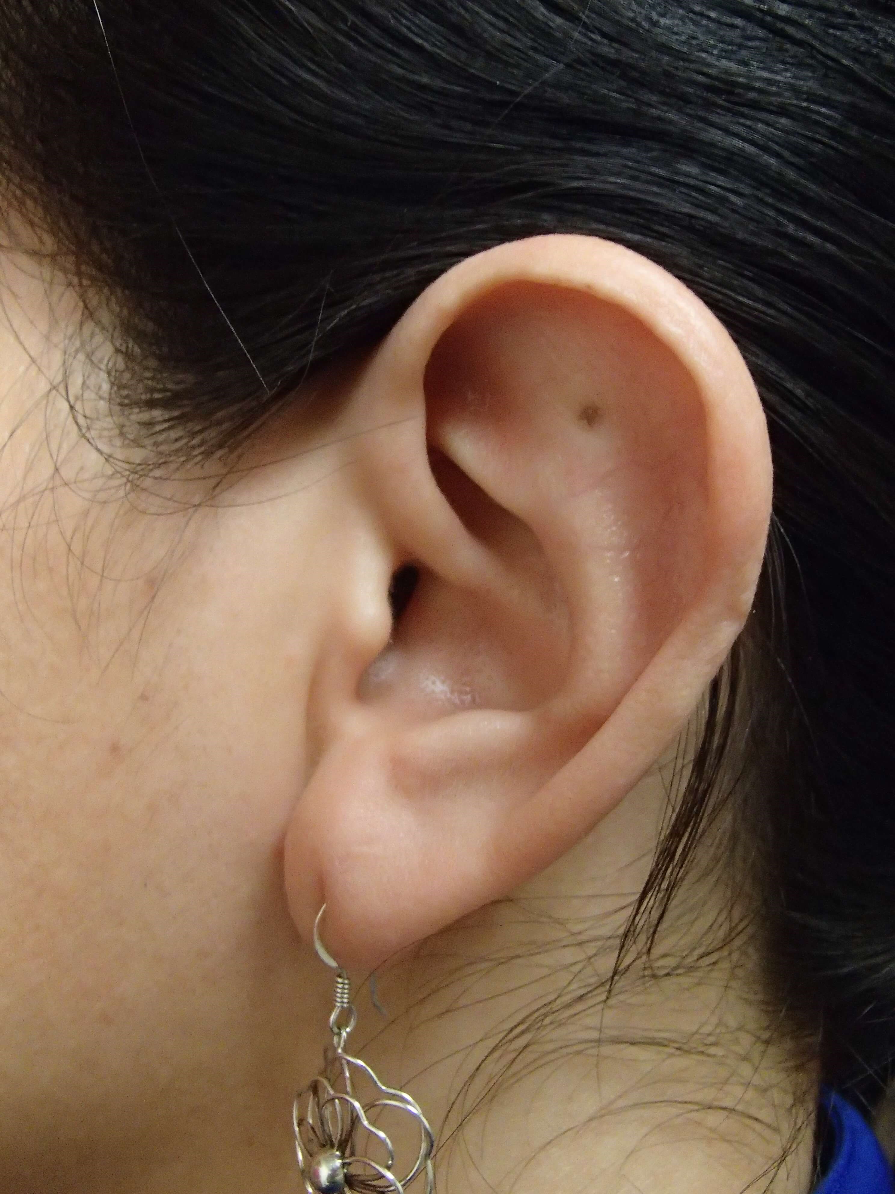 Otoplast - Ear Surgery After
