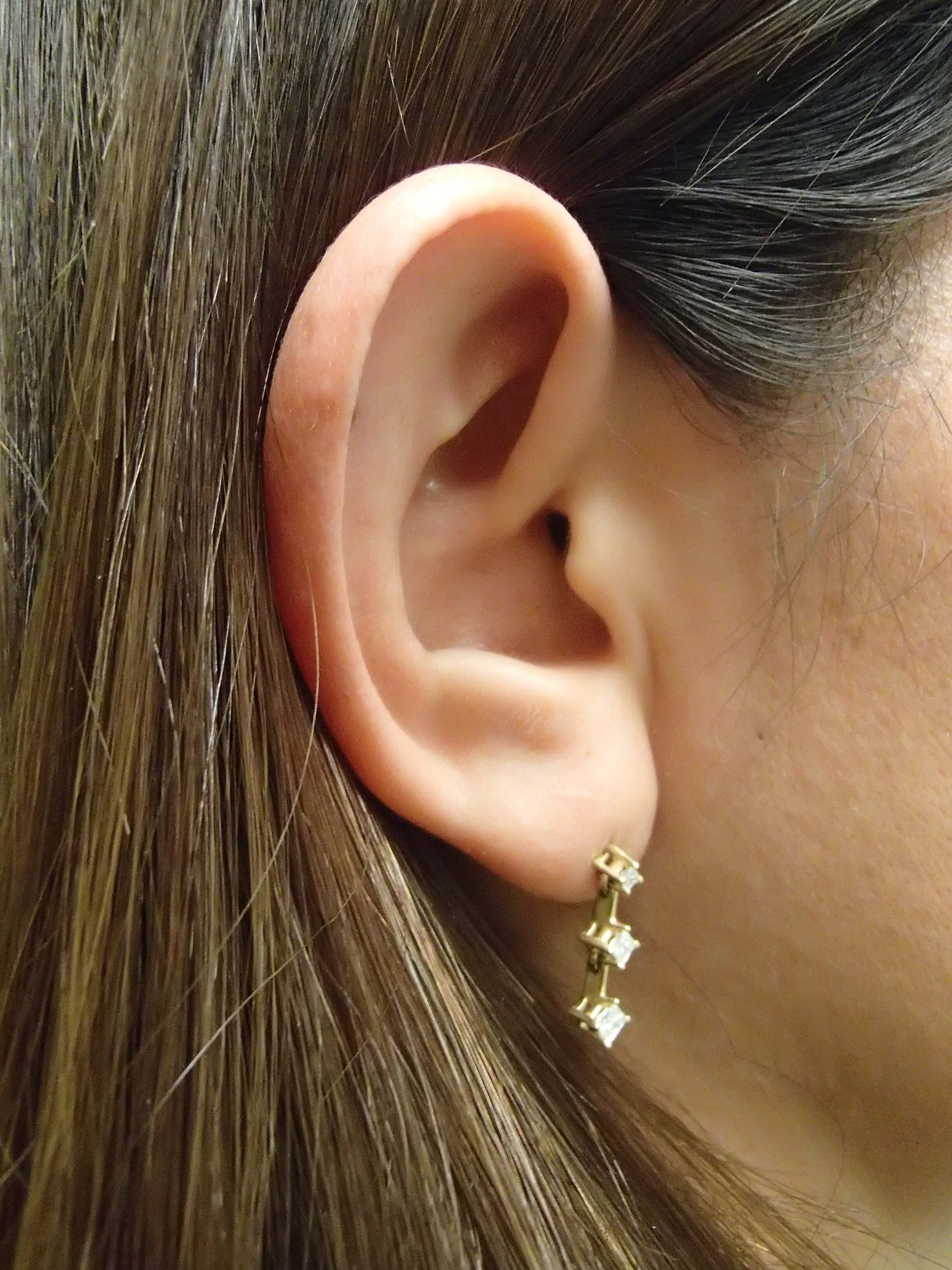 Otoplast - Ear Surgery Before