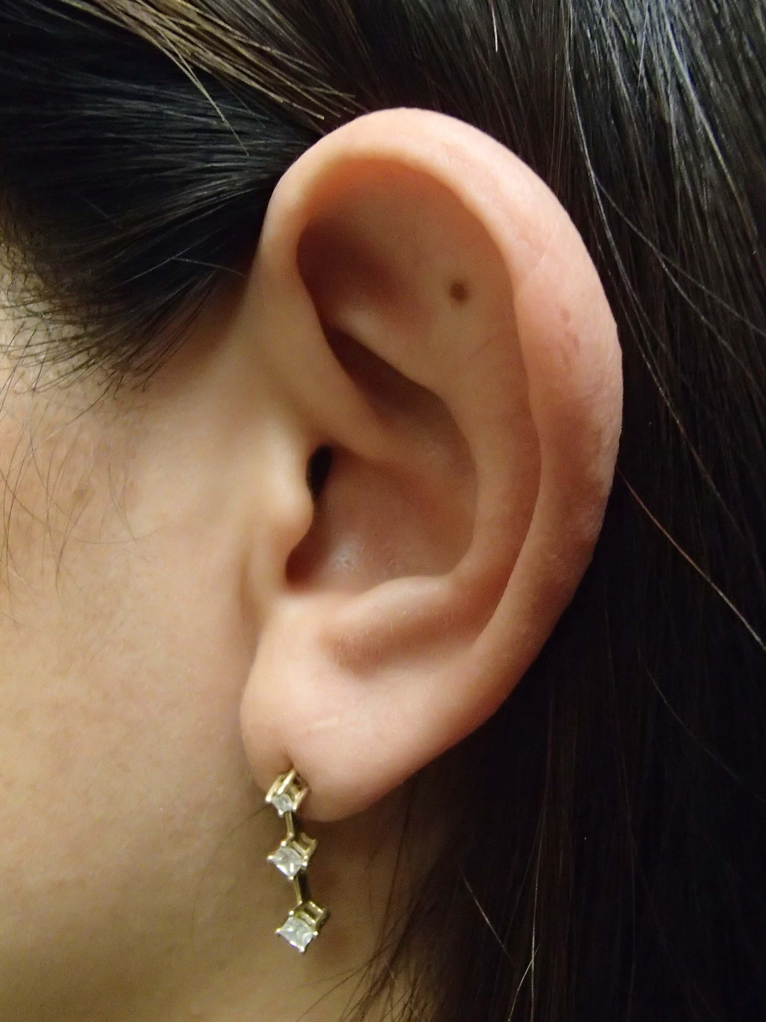 Otoplast - Ear Surgery Before