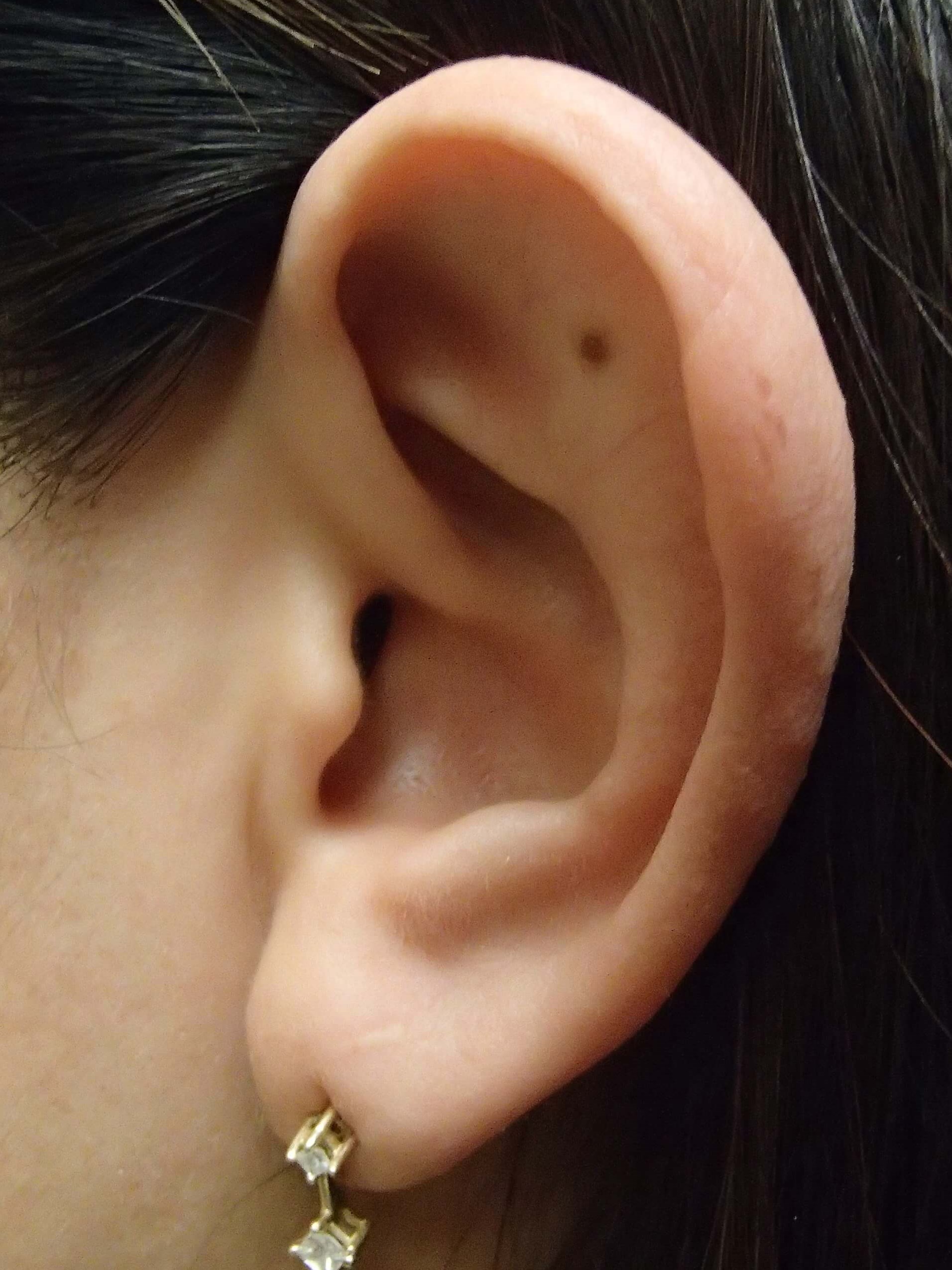 Otoplast - Ear Surgery Before
