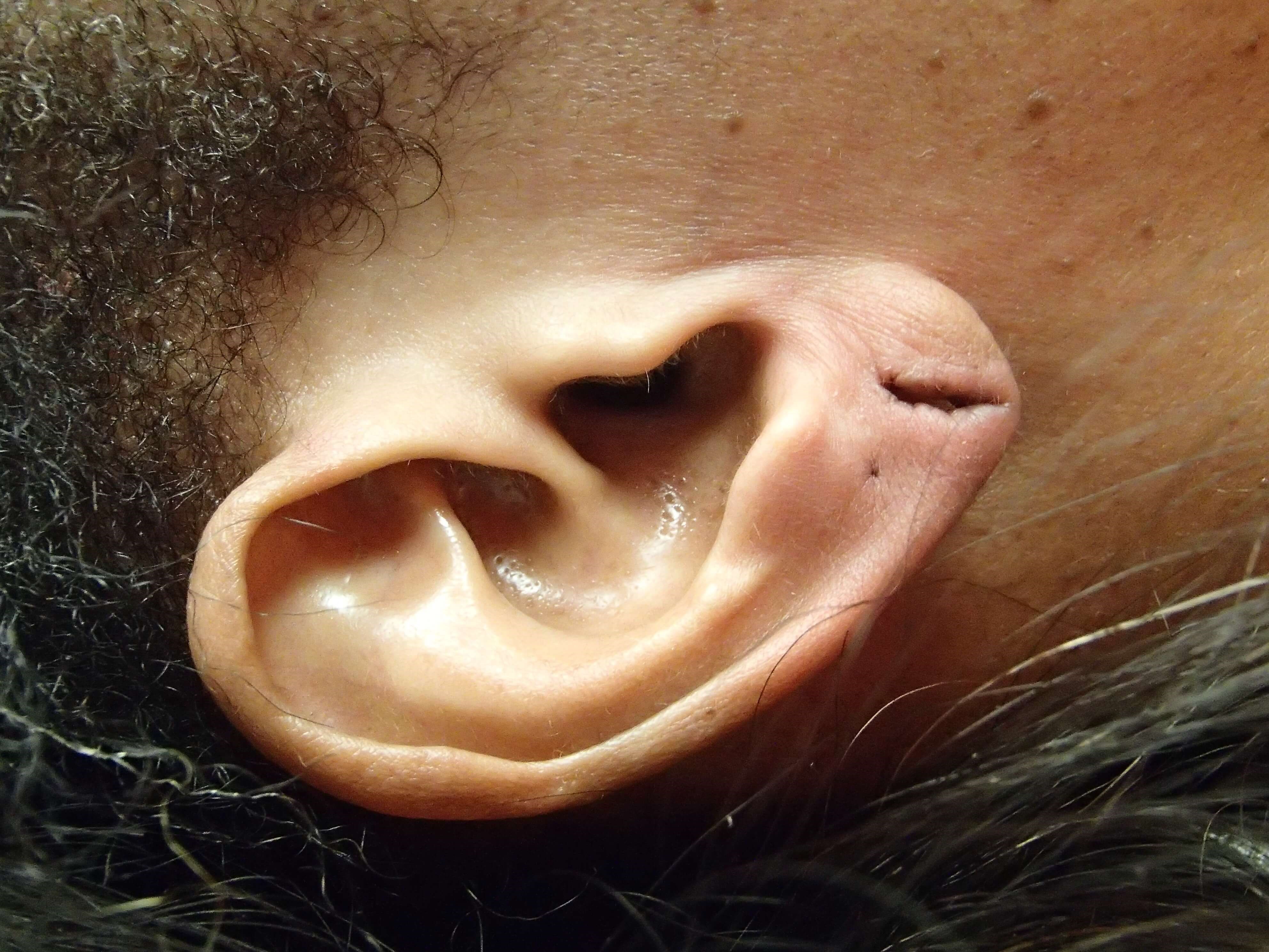 Earlobe Repair Before