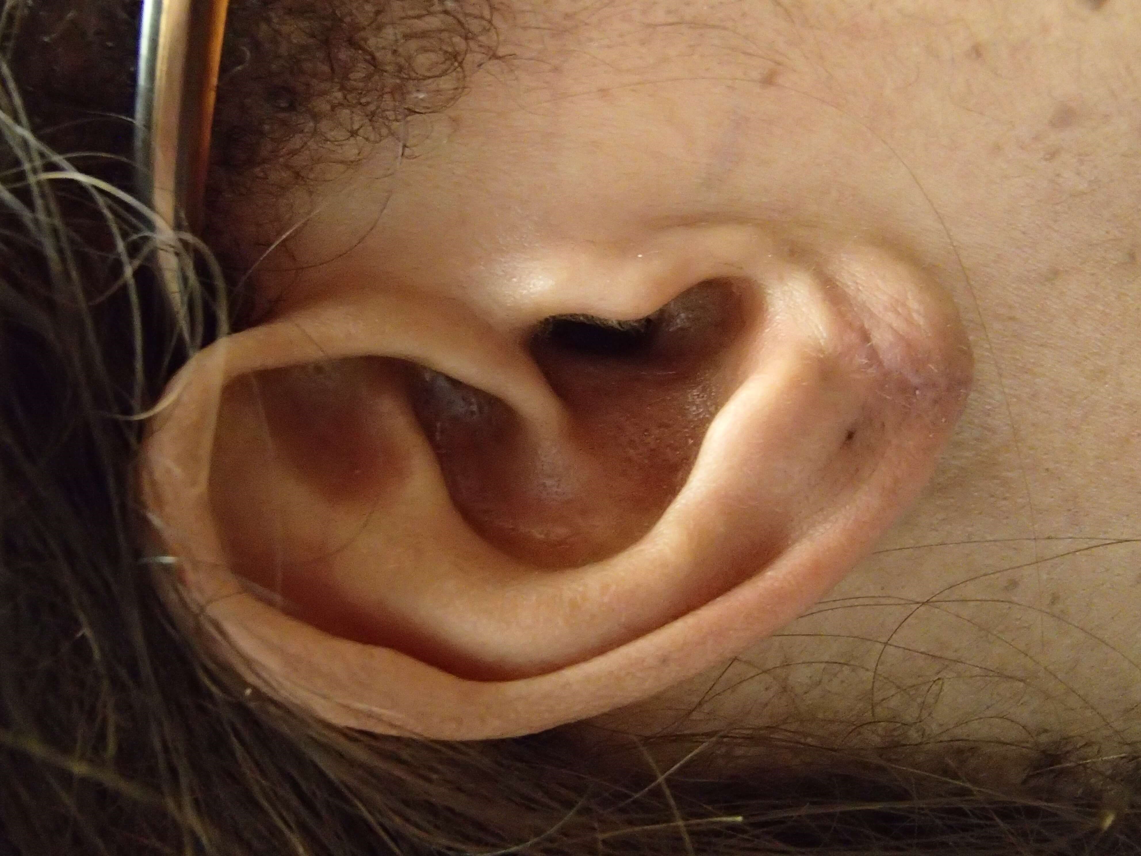 Earlobe Repair After