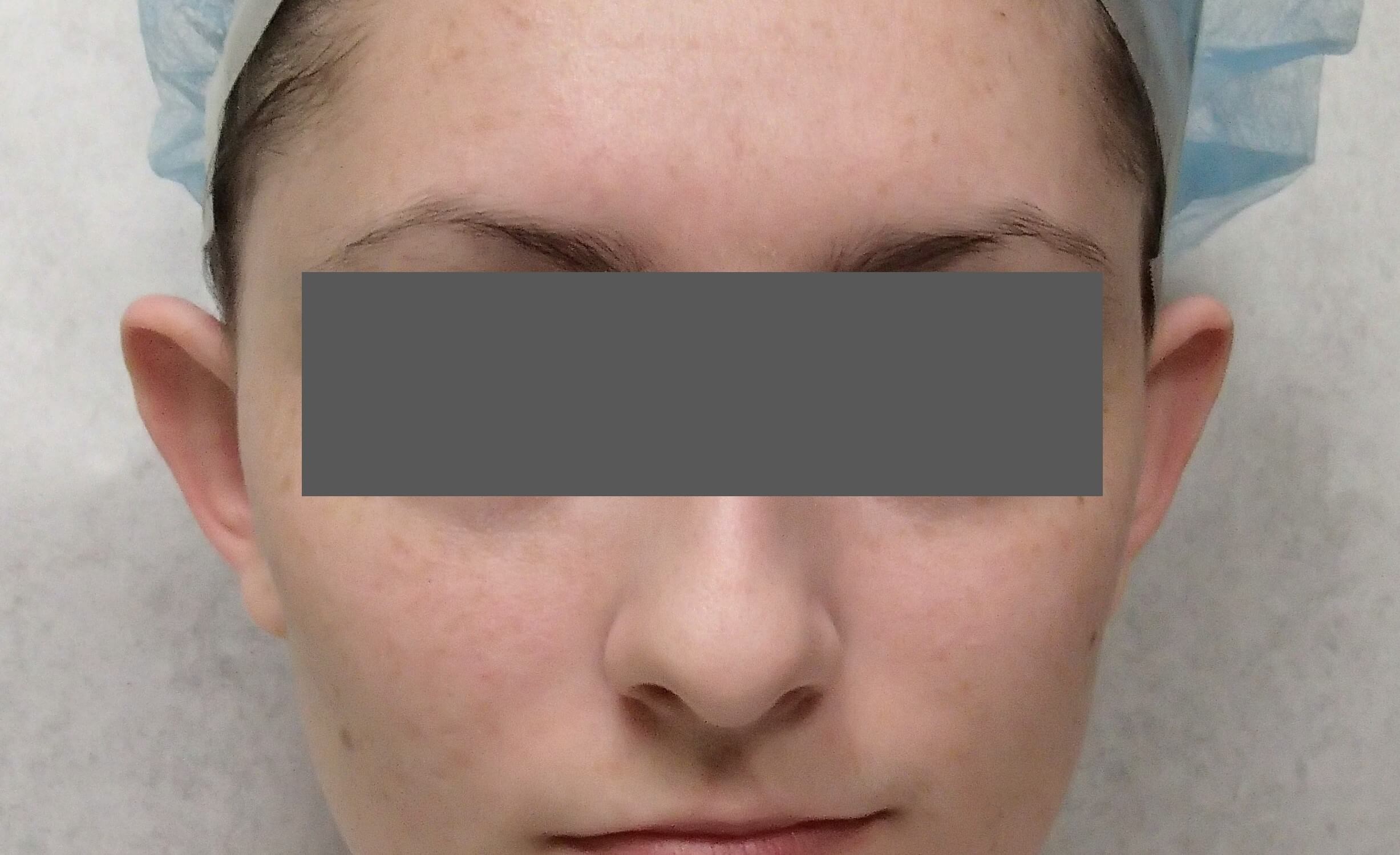 Otoplasty - Ear Surgery Before