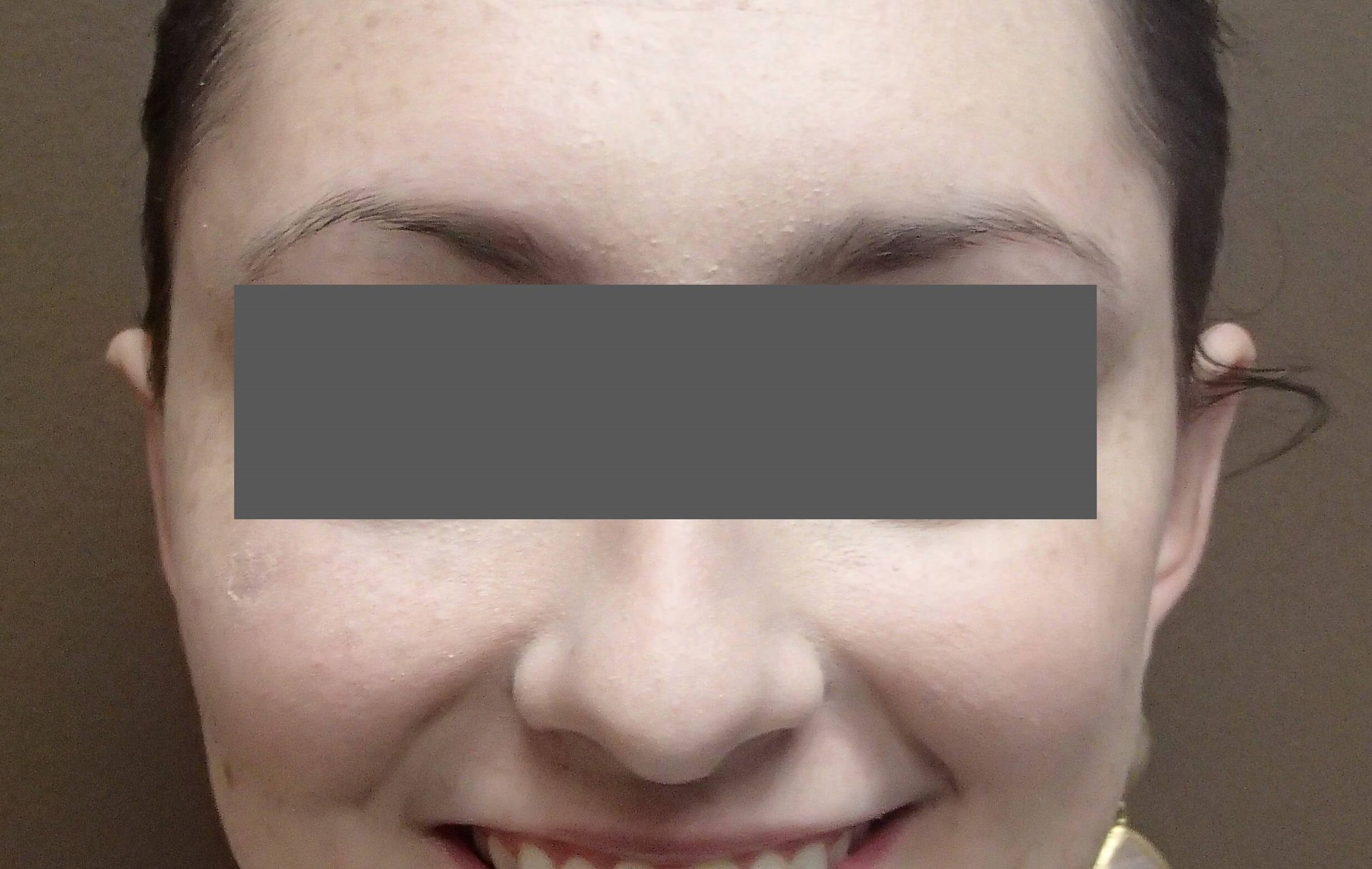 Otoplasty - Ear Surgery After
