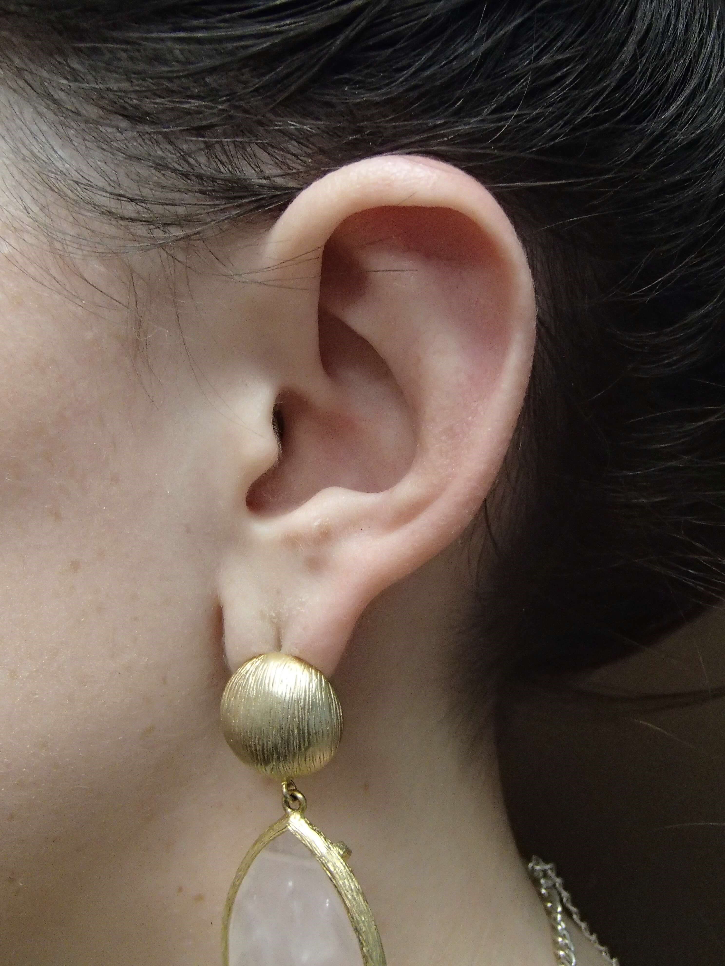 Otoplasty - Ear Surgery After