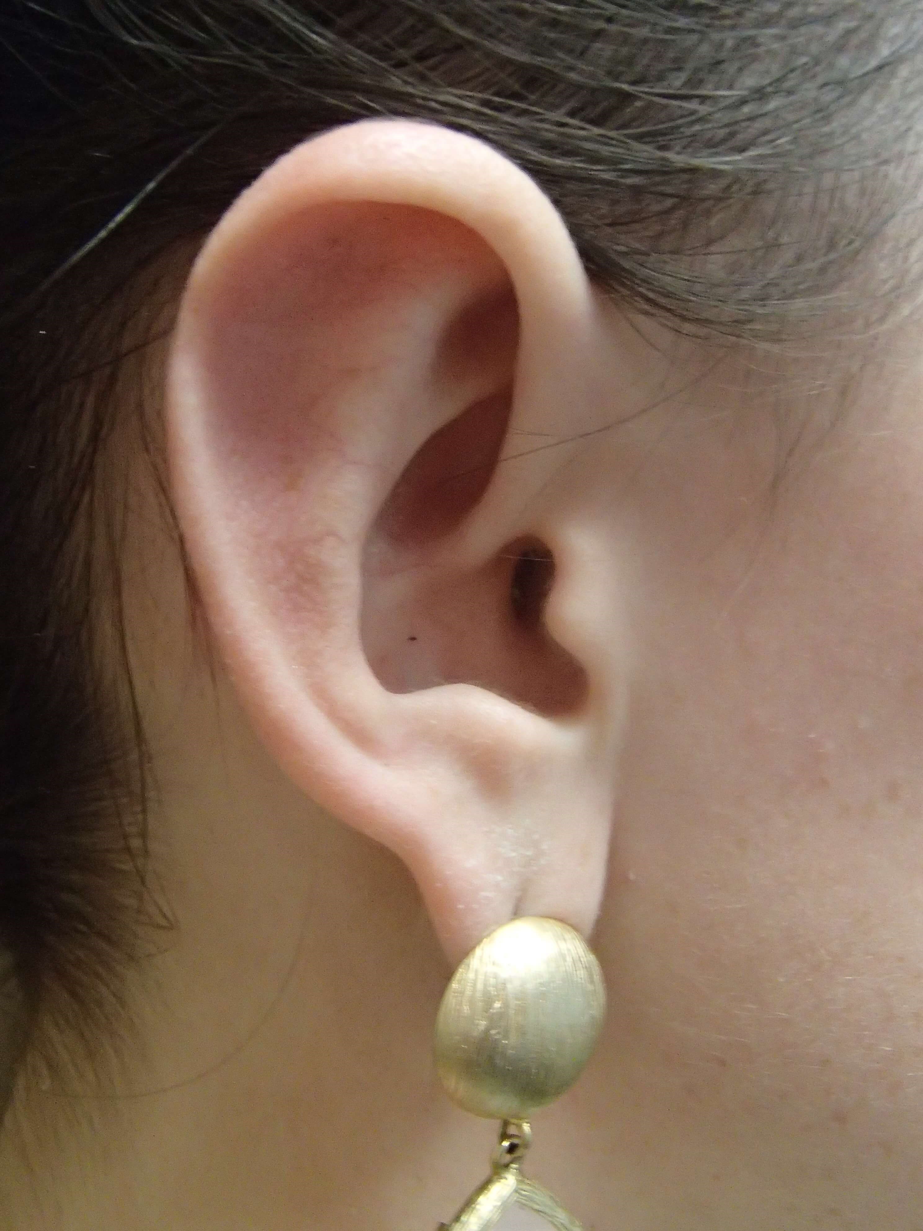 Otoplast - Ear Surgery After