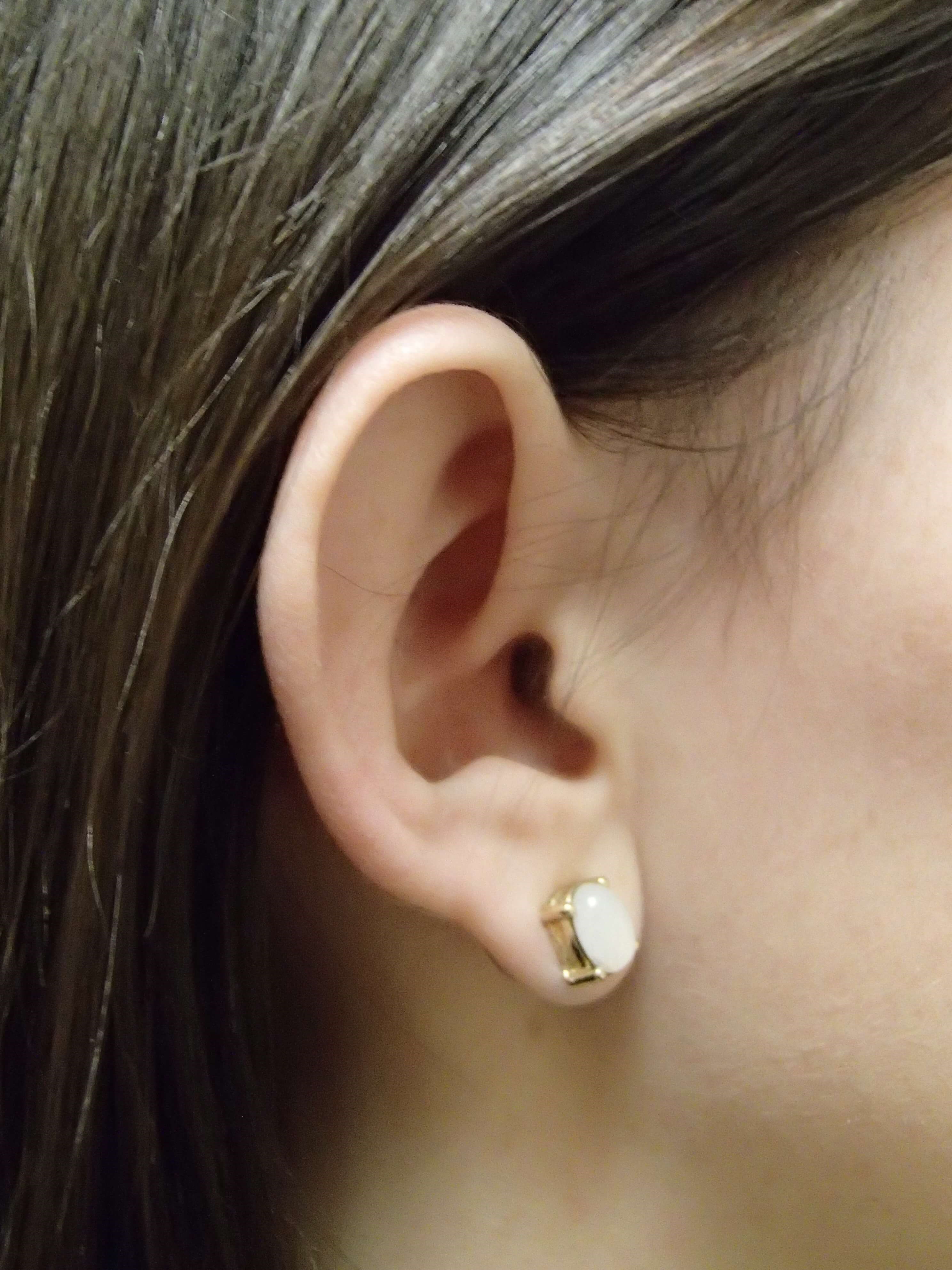 Otoplast - Ear Surgery Before
