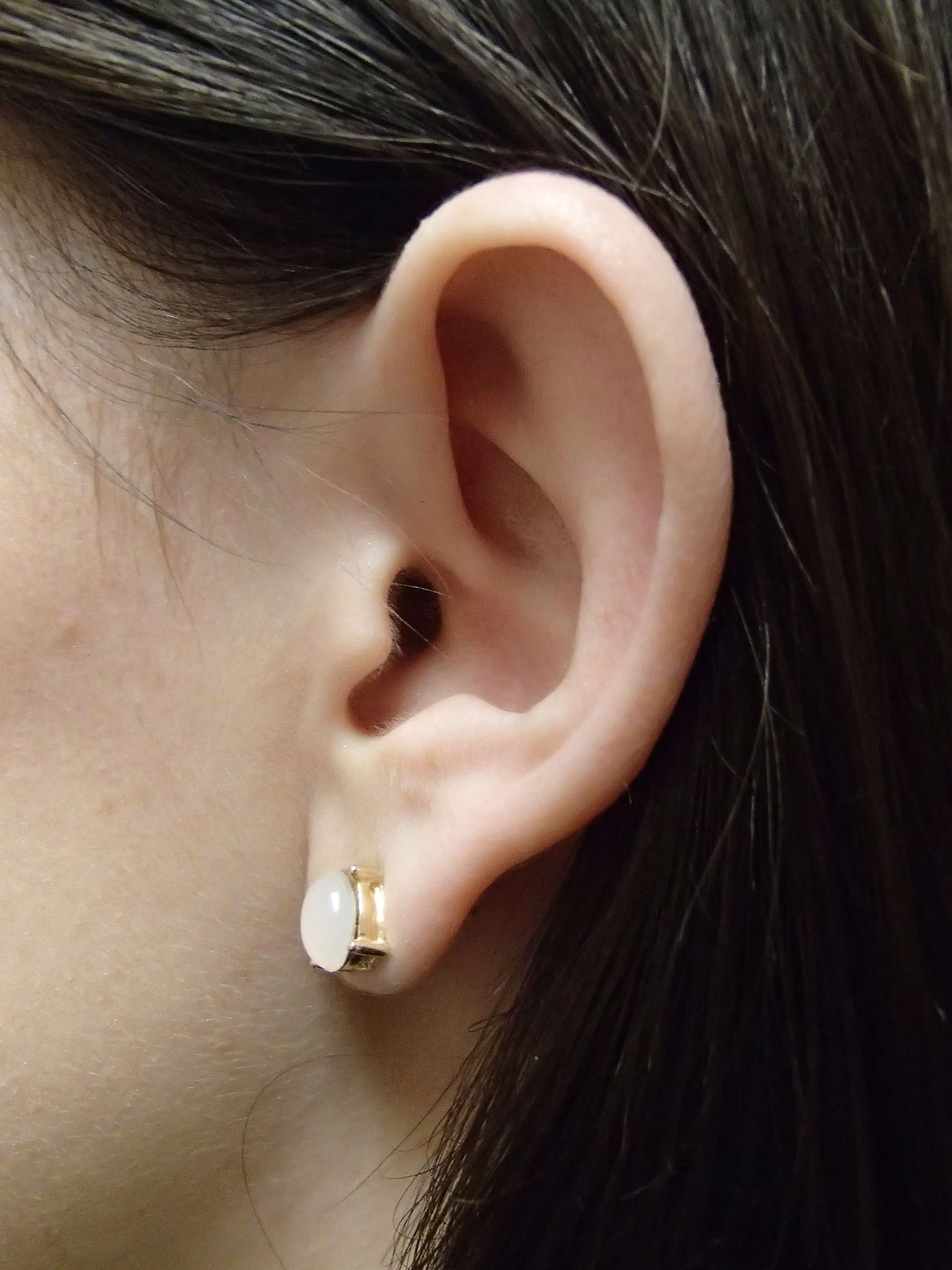 Otoplasty - Ear Surgery Before