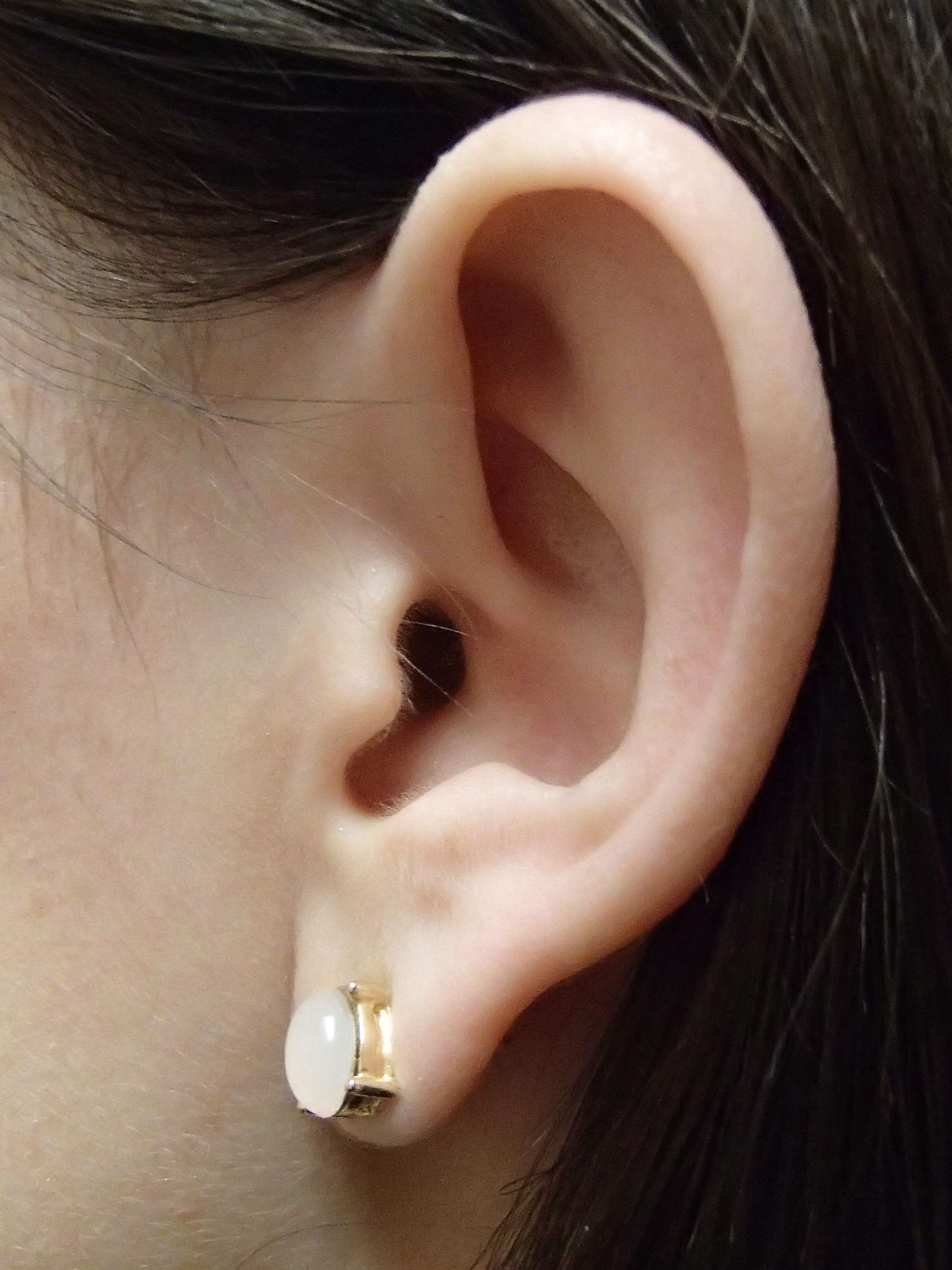 Otoplasty - Ear Surgery Before