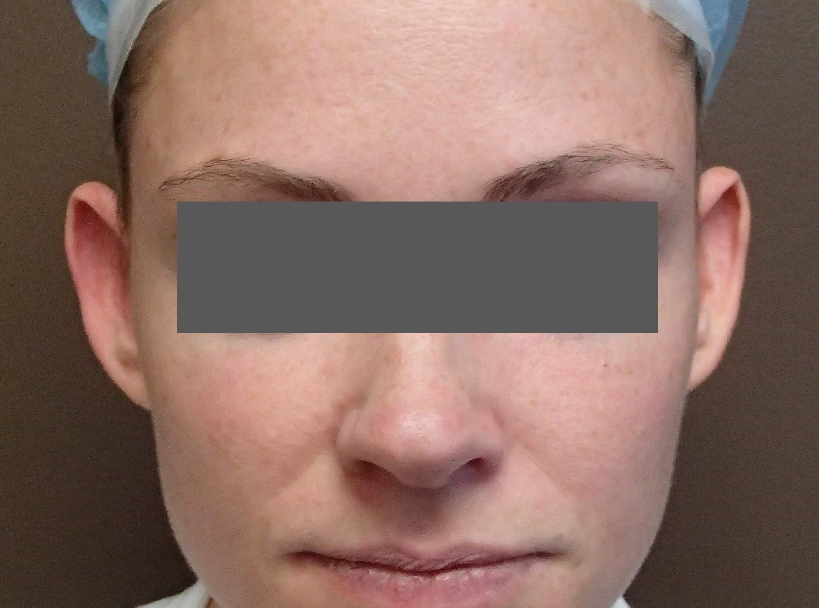 Otoplasty - Ear Surgery Before