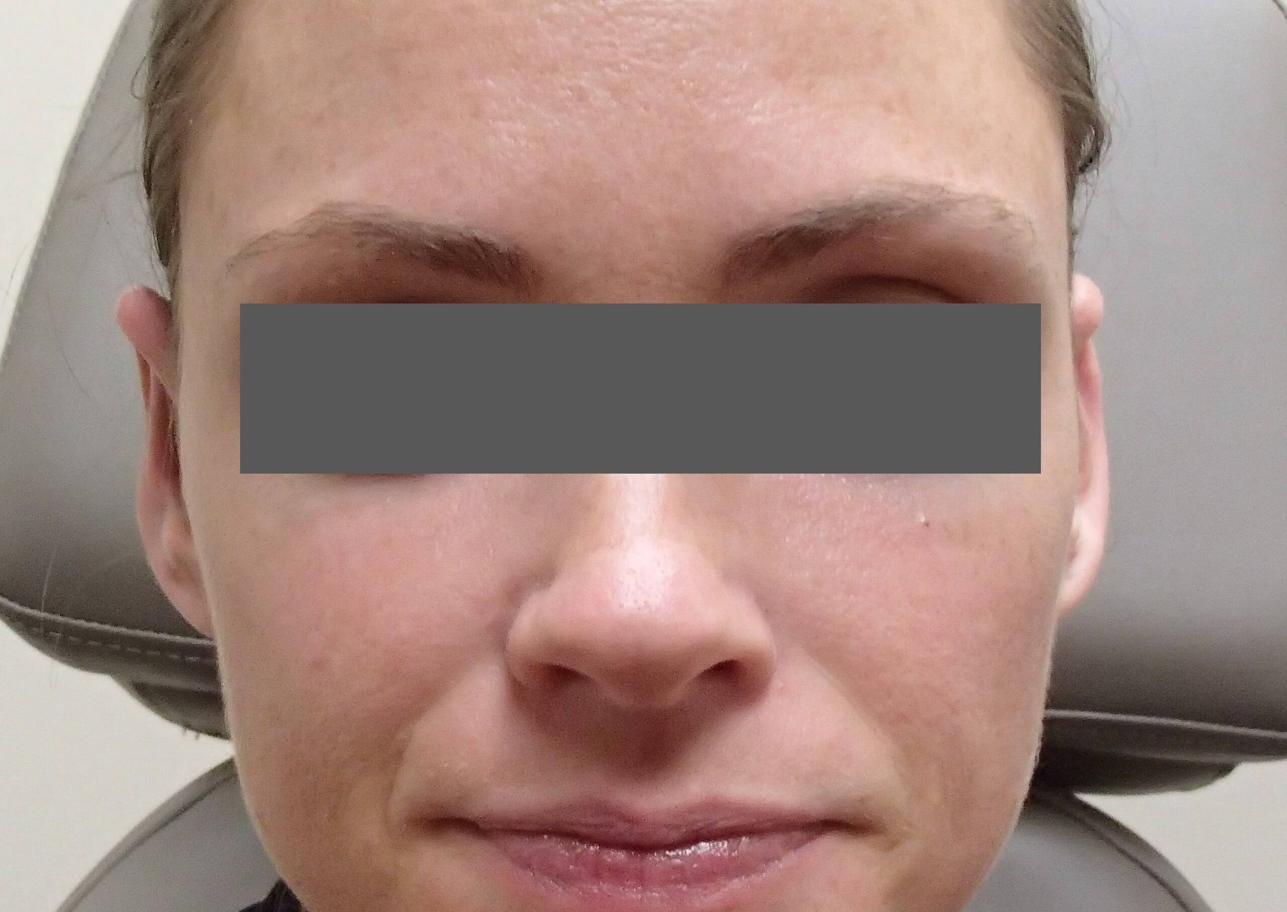 Otoplasty - Ear Surgery After