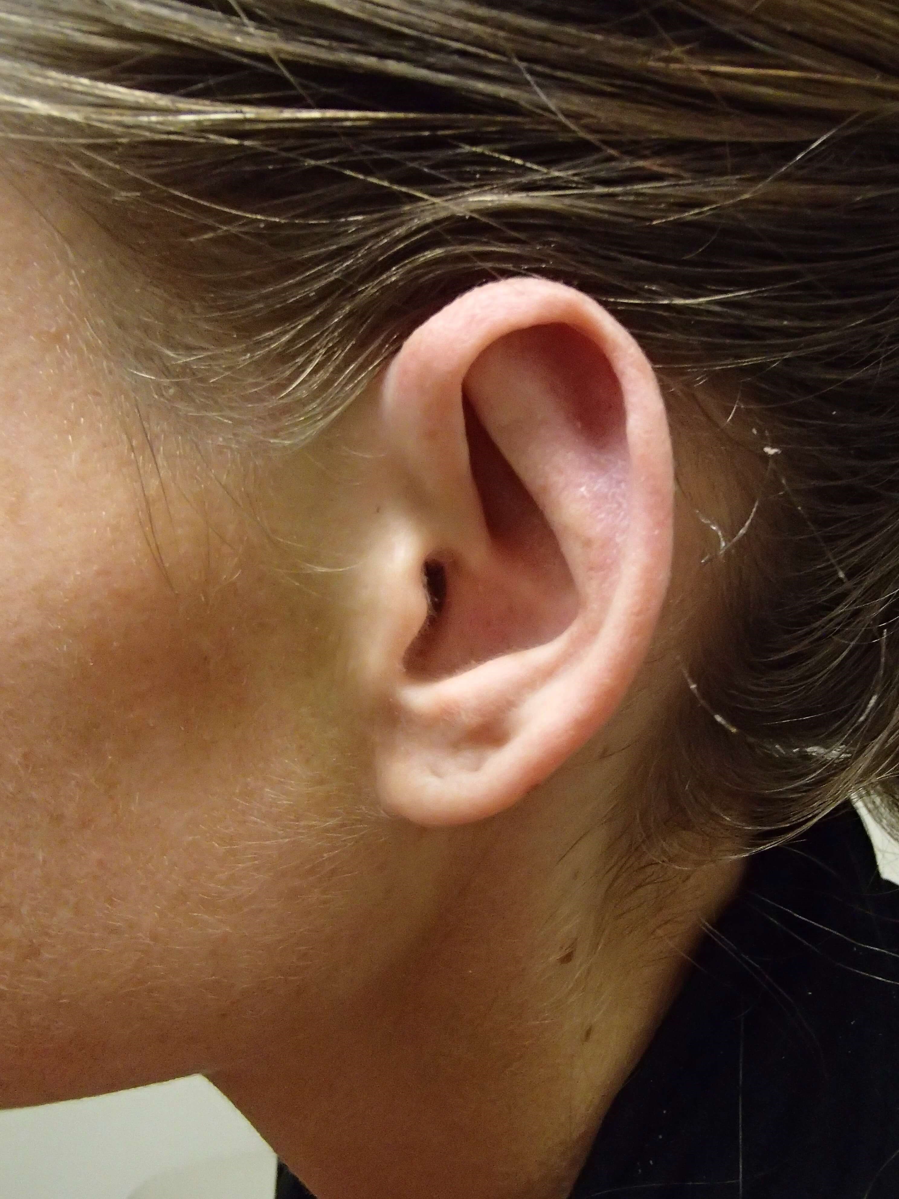 Otoplasty - Ear Surgery After