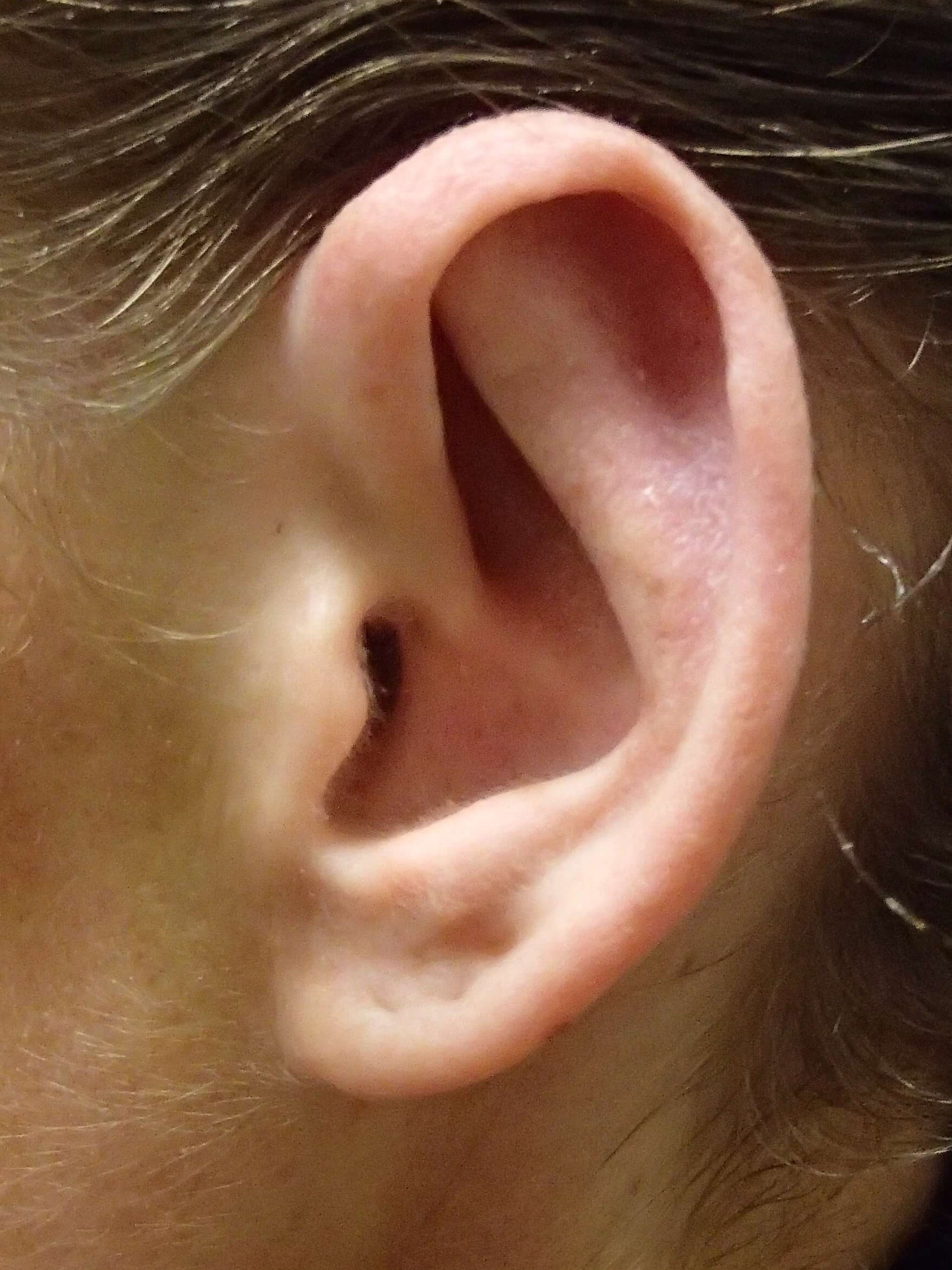 Otoplasty - Ear Surgery After