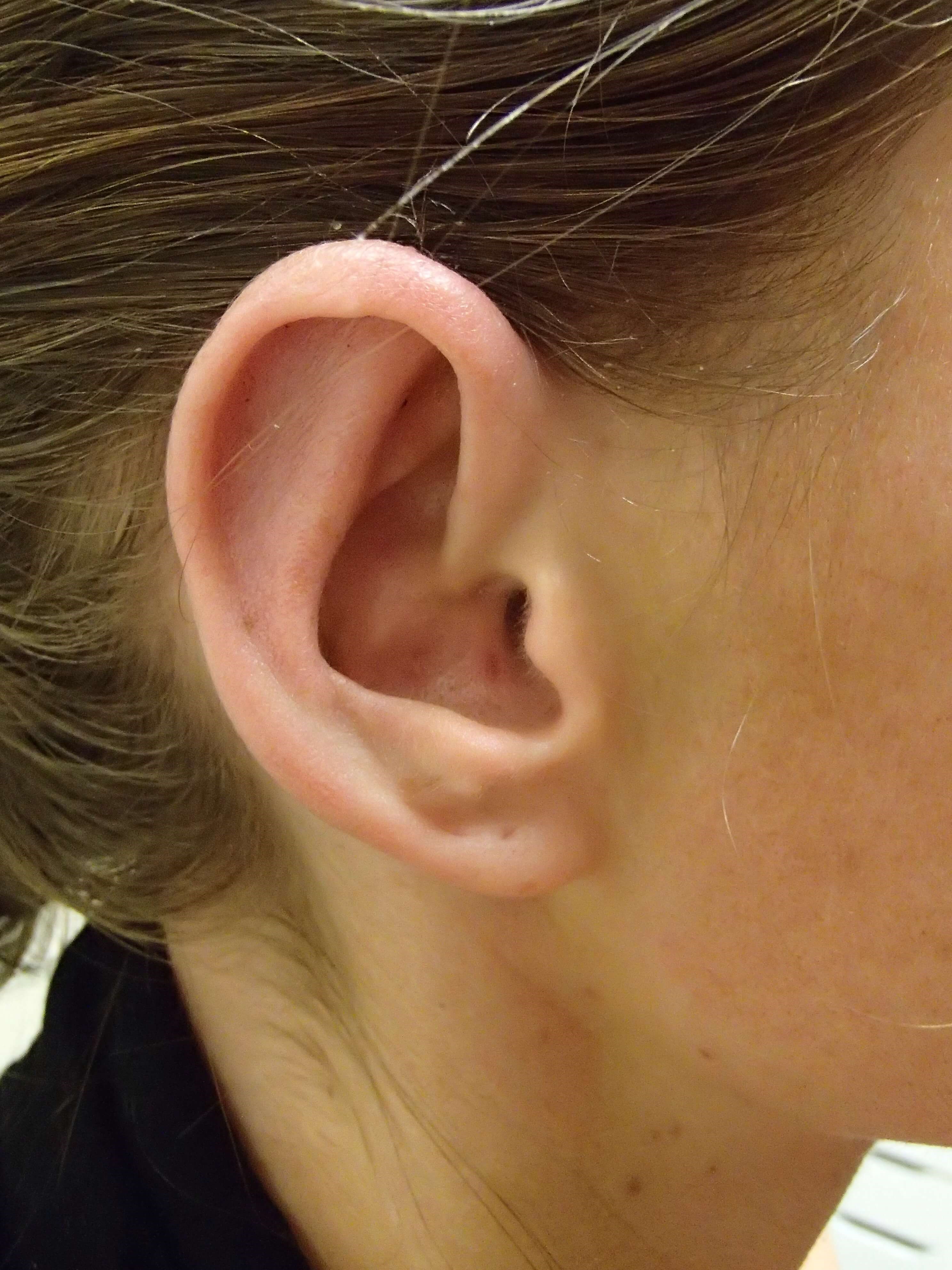 Otoplasty - Ear Surgery After