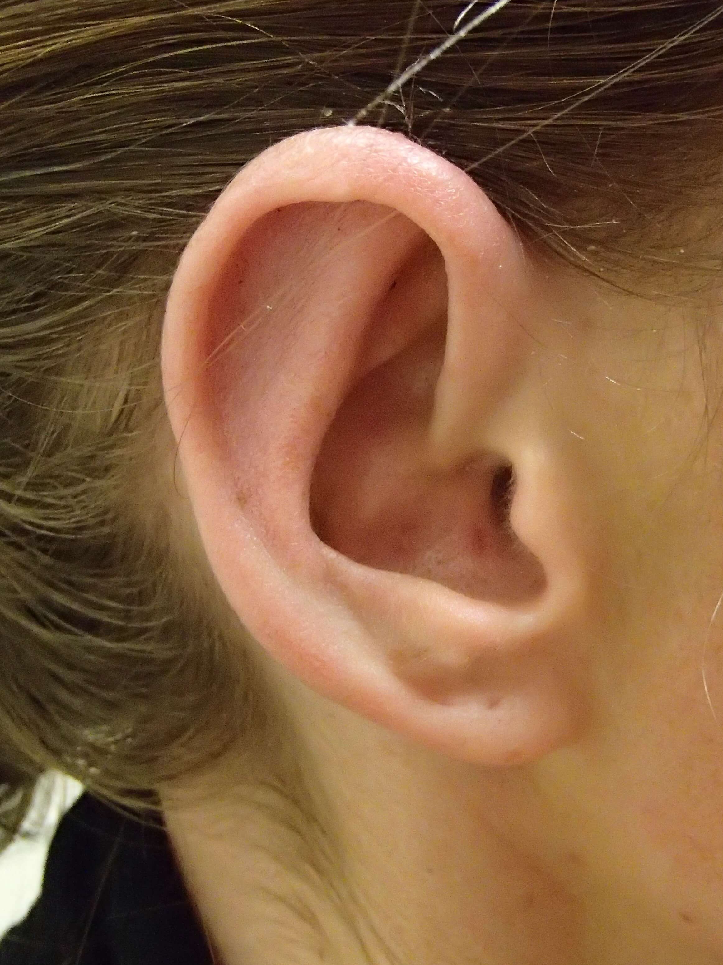 Otoplasty - Ear Surgery After