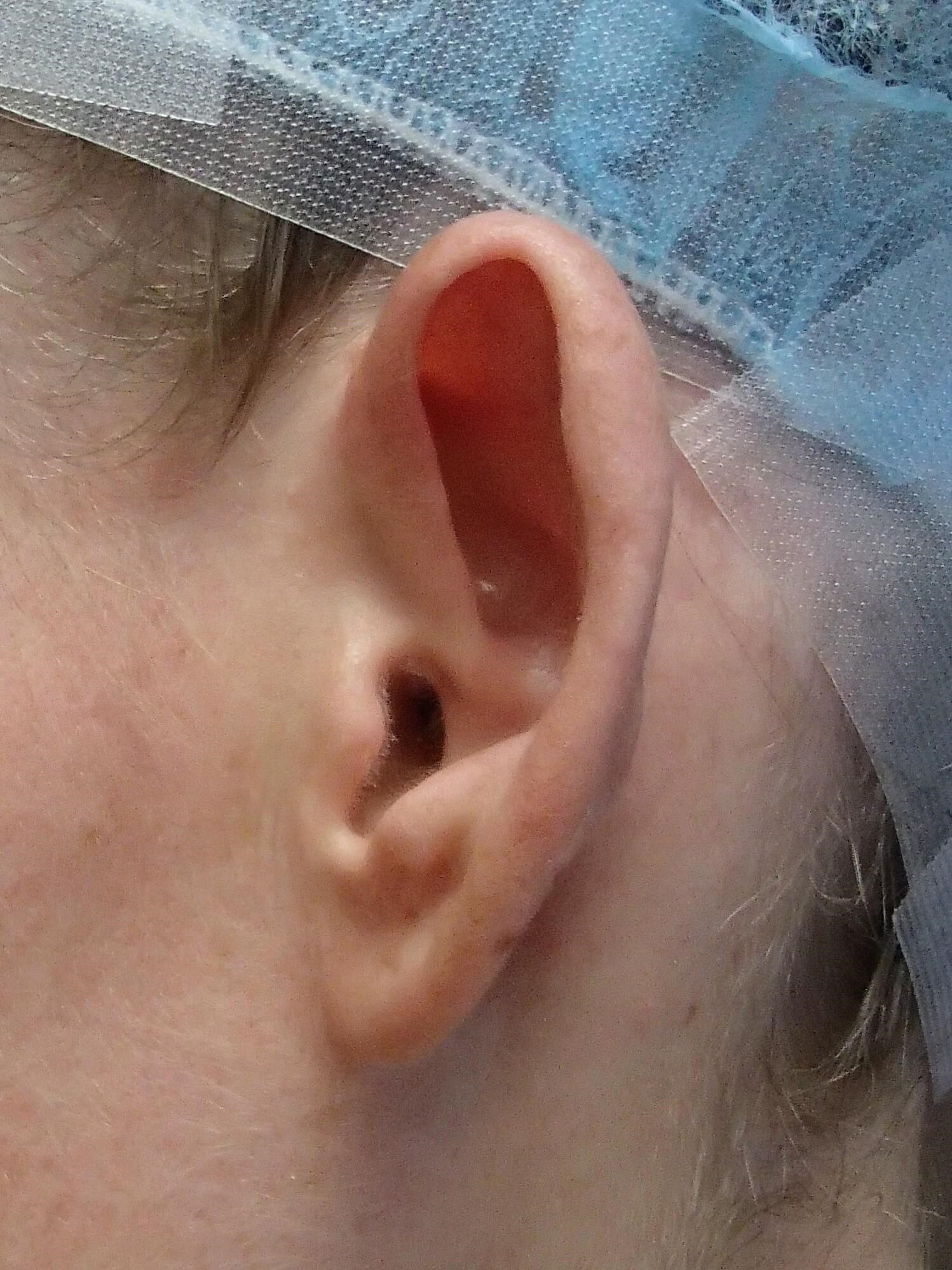 Otoplasty - Ear Surgery Before