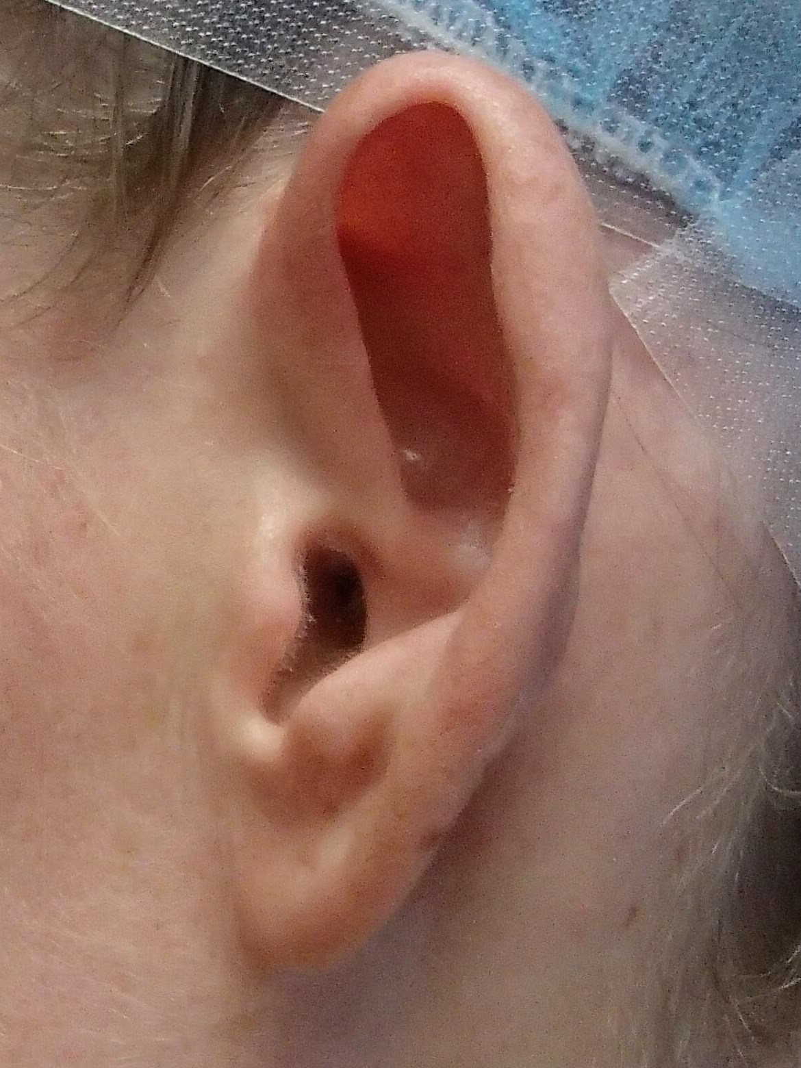 Otoplasty - Ear Surgery Before