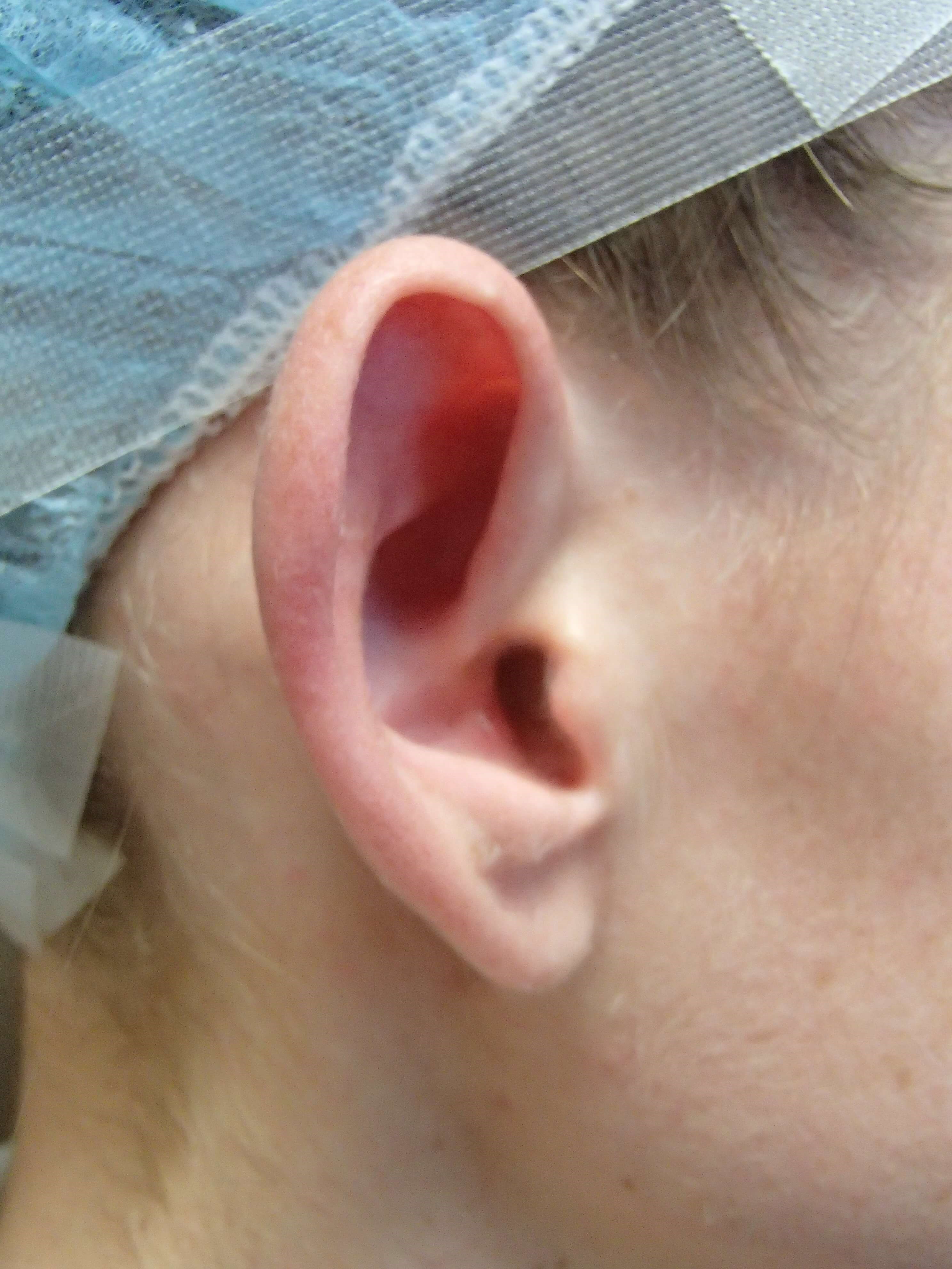 Otoplasty - Ear Surgery Before