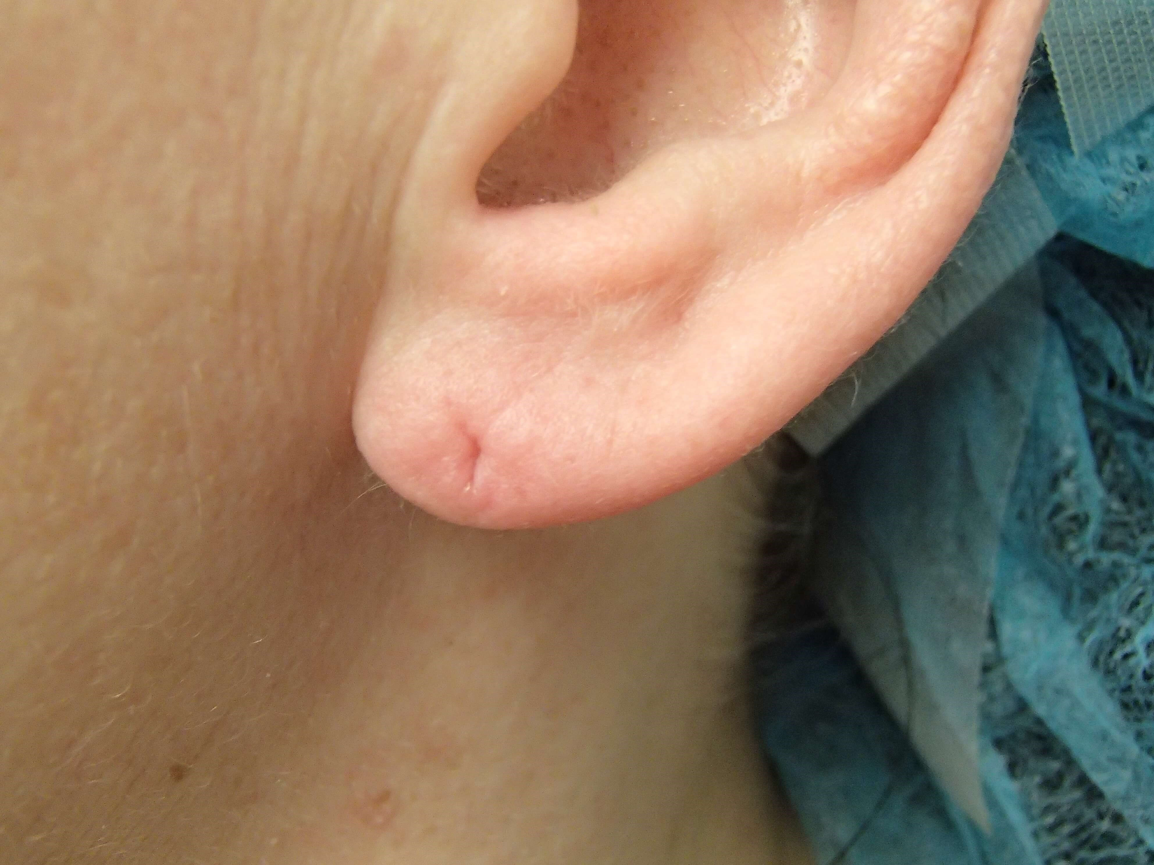 Earlobe Repair Before