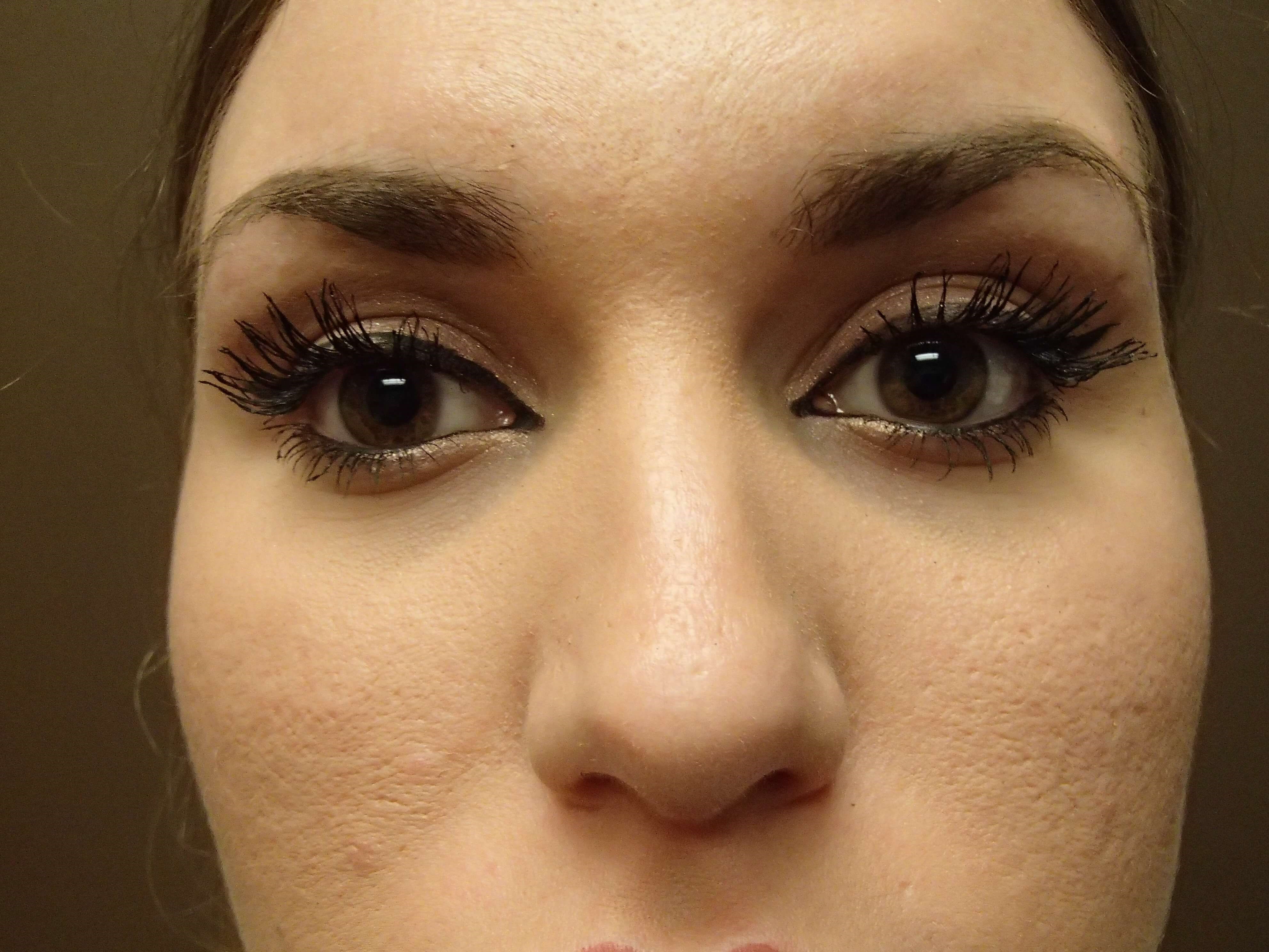 Rhinoplasty Before