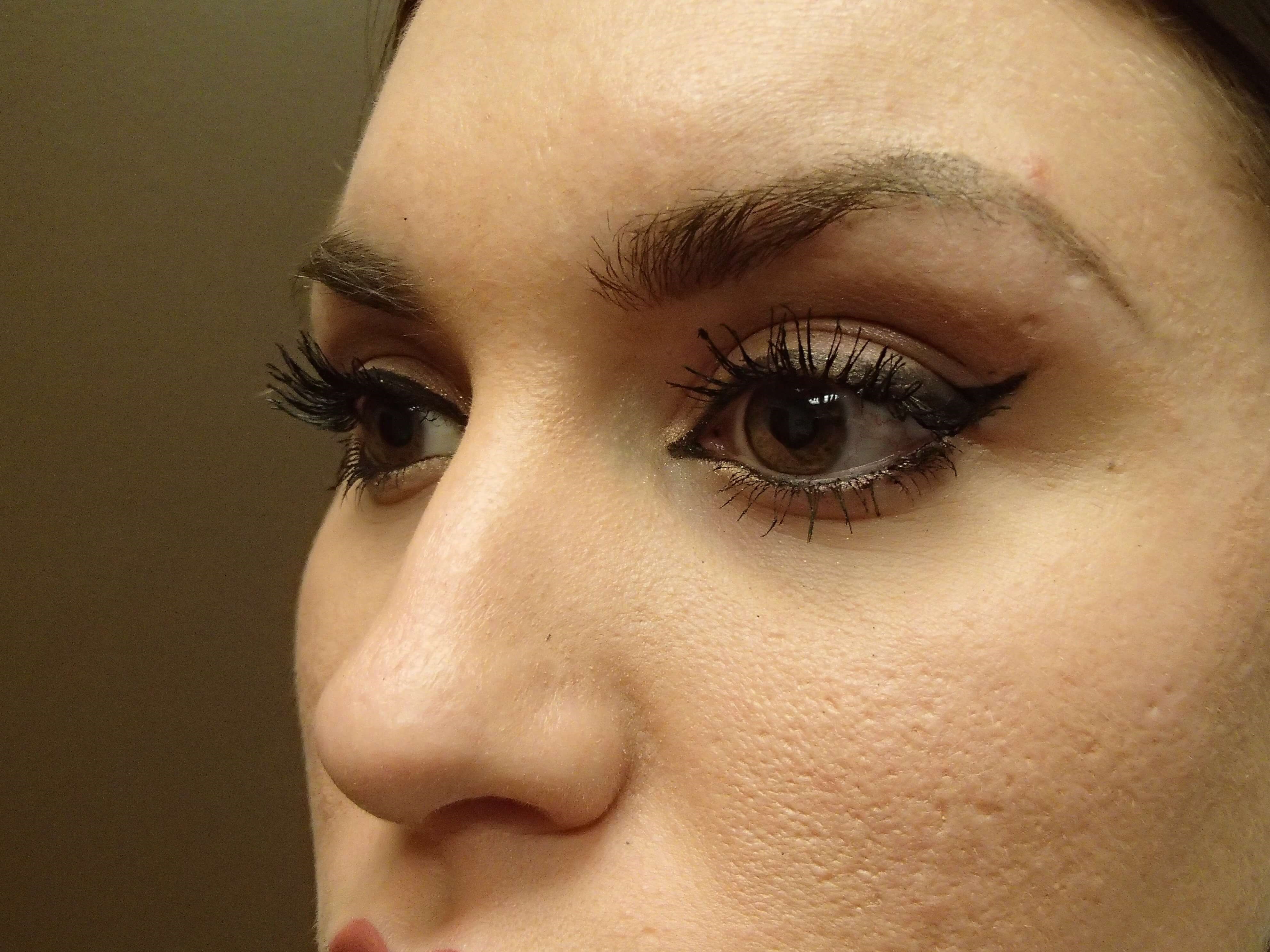 Rhinoplasty Before