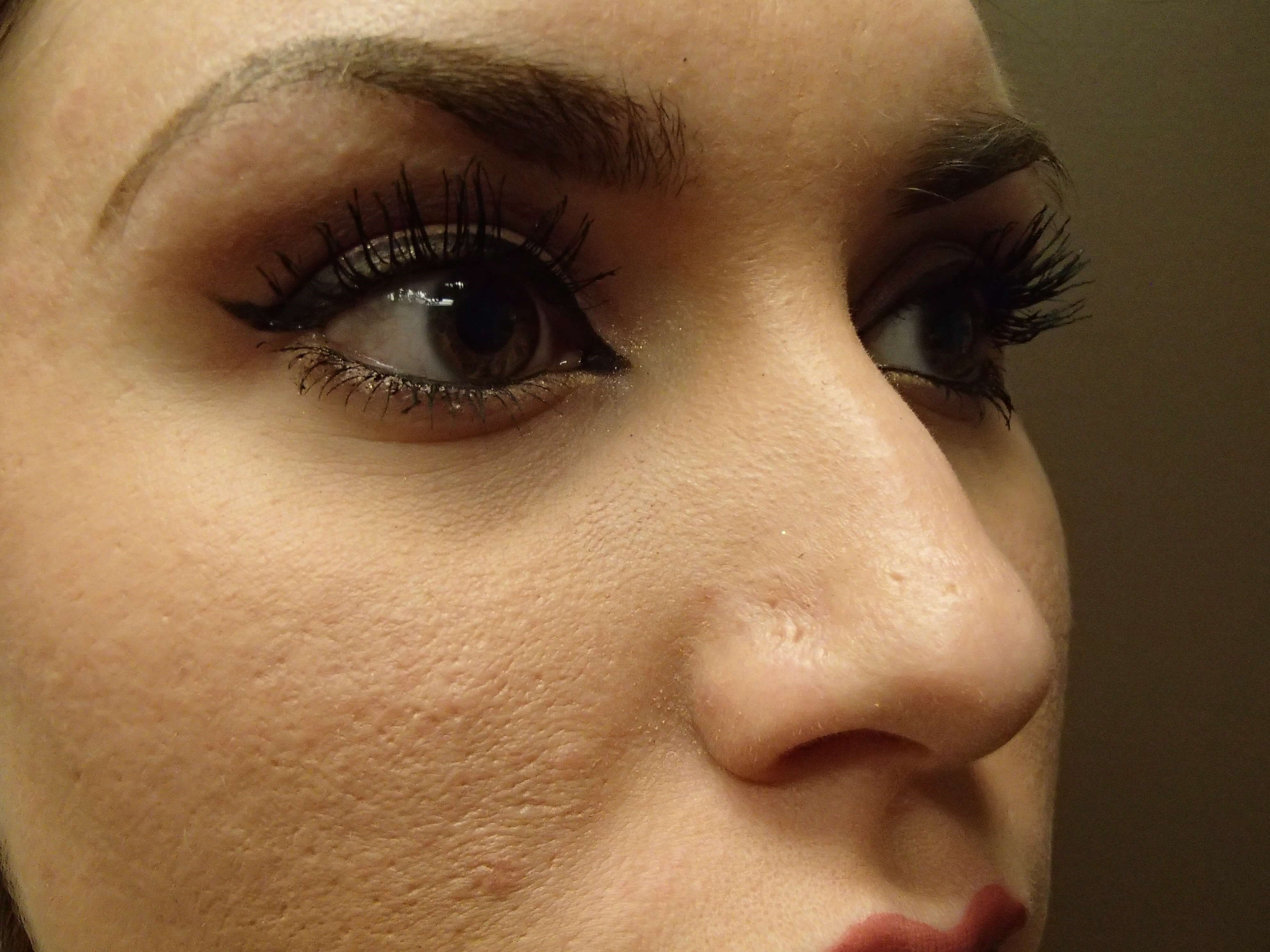 Rhinoplasty Before