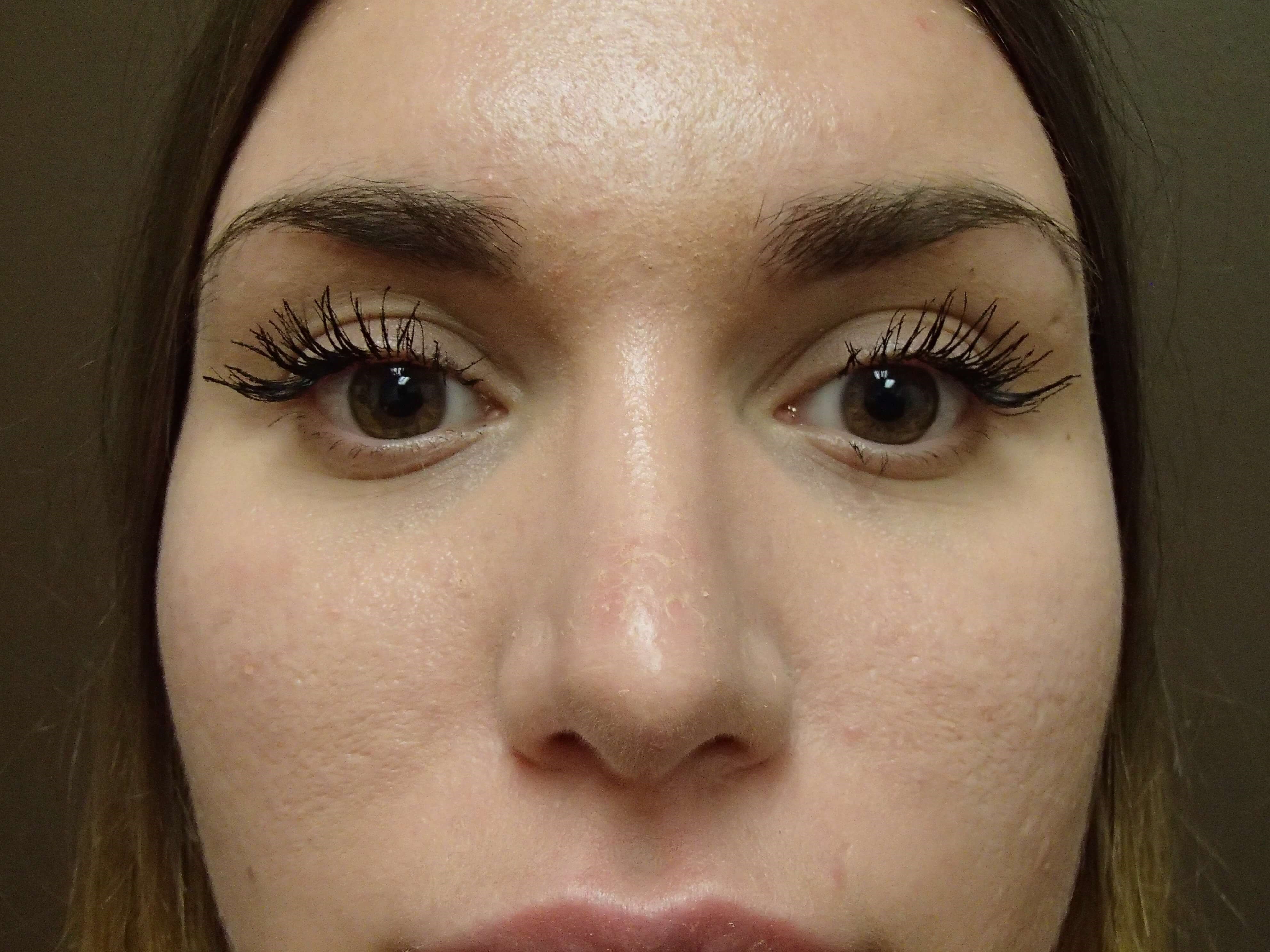 Rhinoplasty After