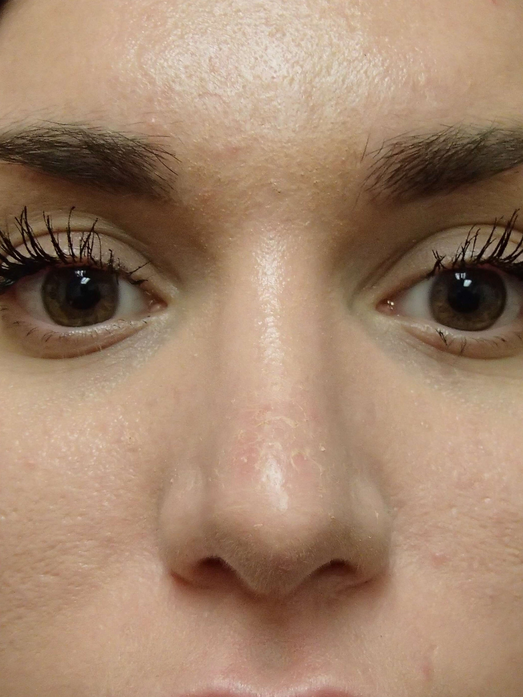 Rhinoplasty After