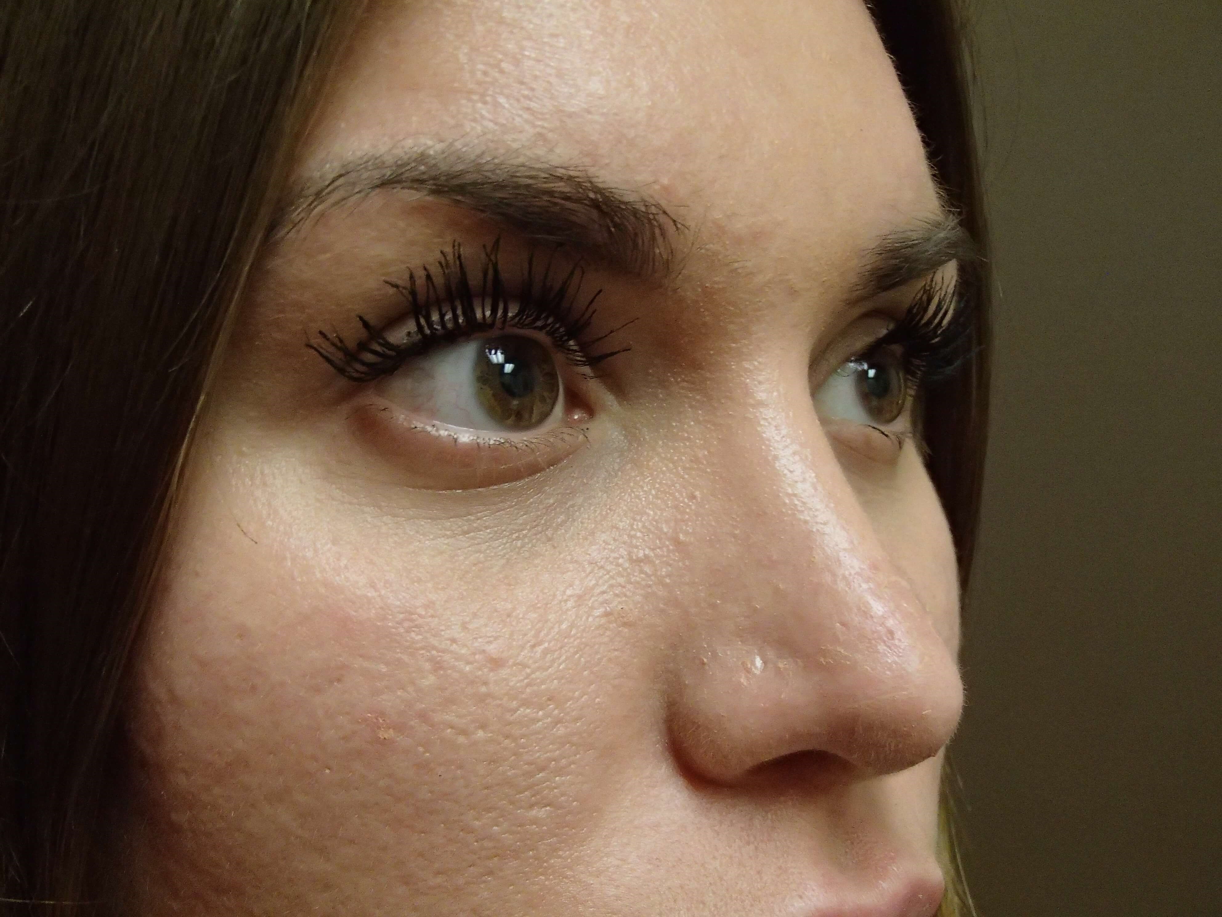 Rhinoplasty After