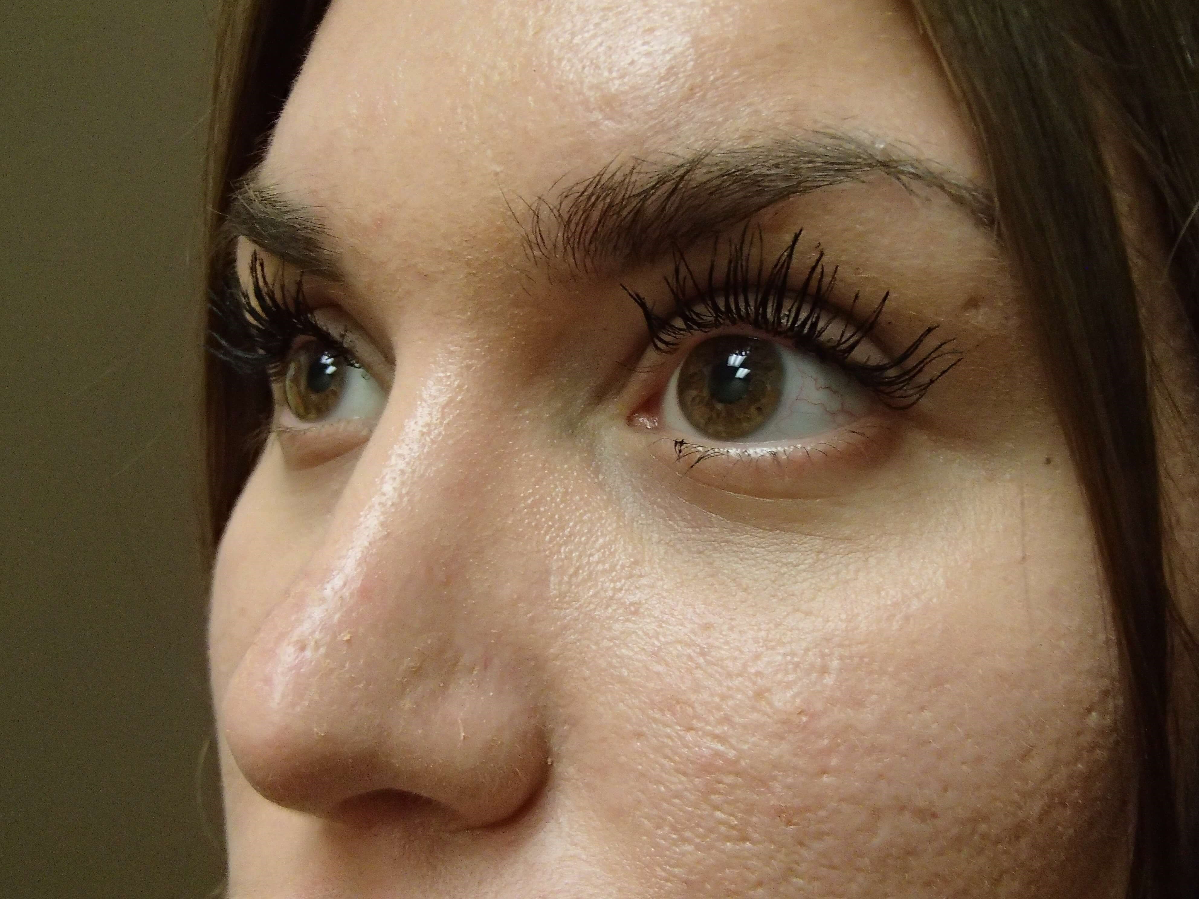 Rhinoplasty After