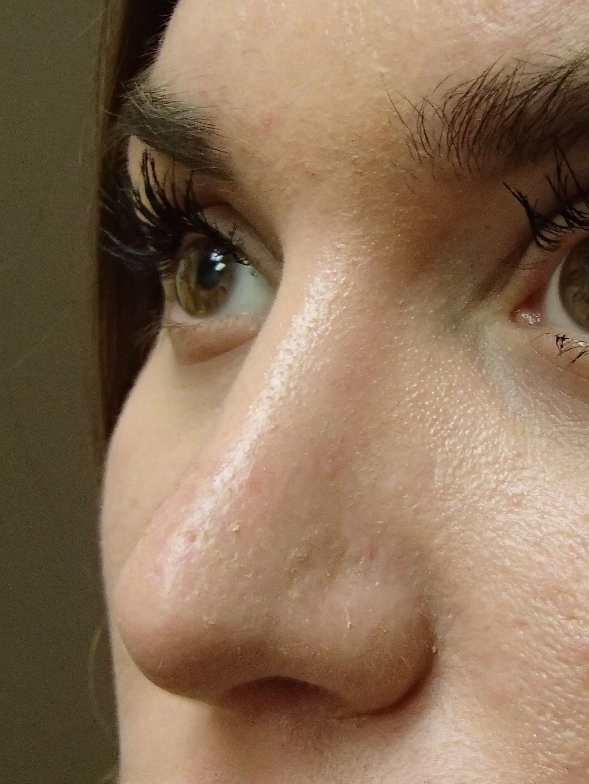 Rhinoplasty After