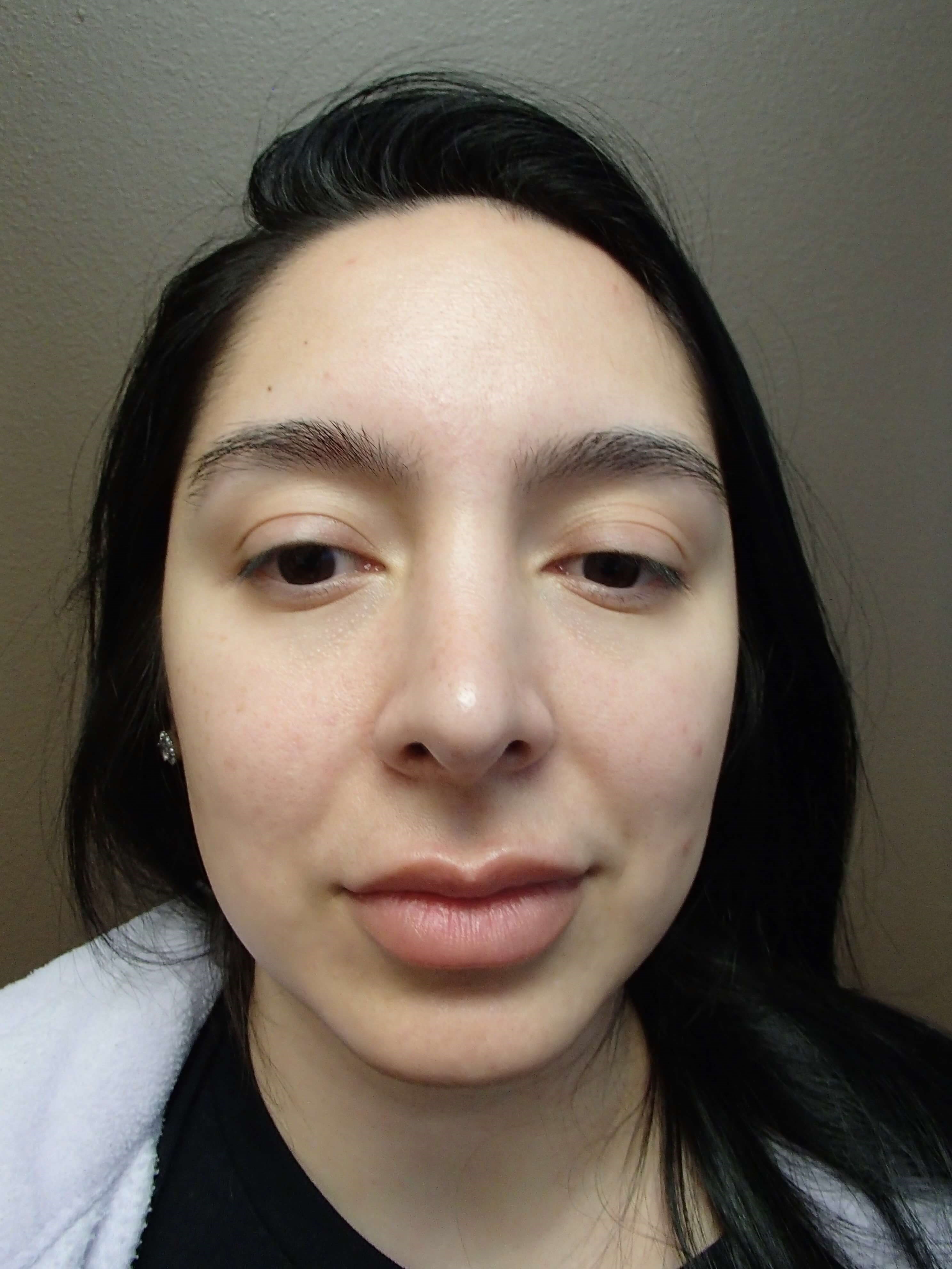 Rhinoplasty w/ Septoplasty After