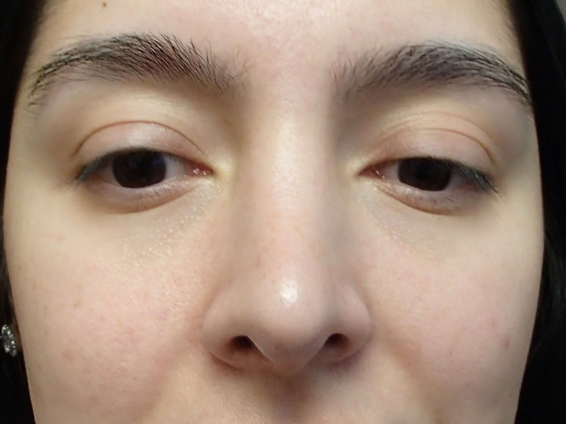 Rhinoplasty w/ Septoplasty After