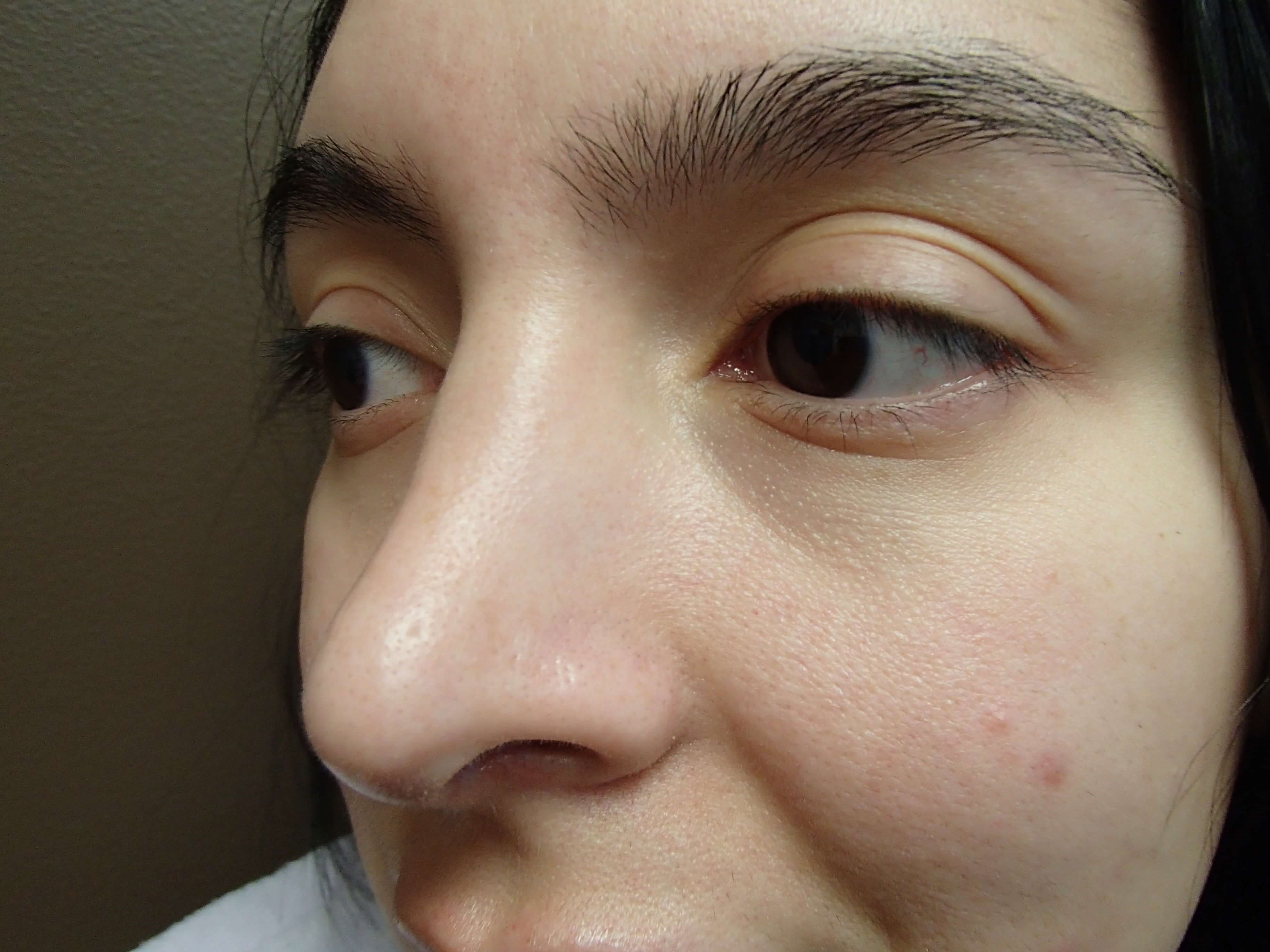 Rhinoplasty w/ Septoplasty After