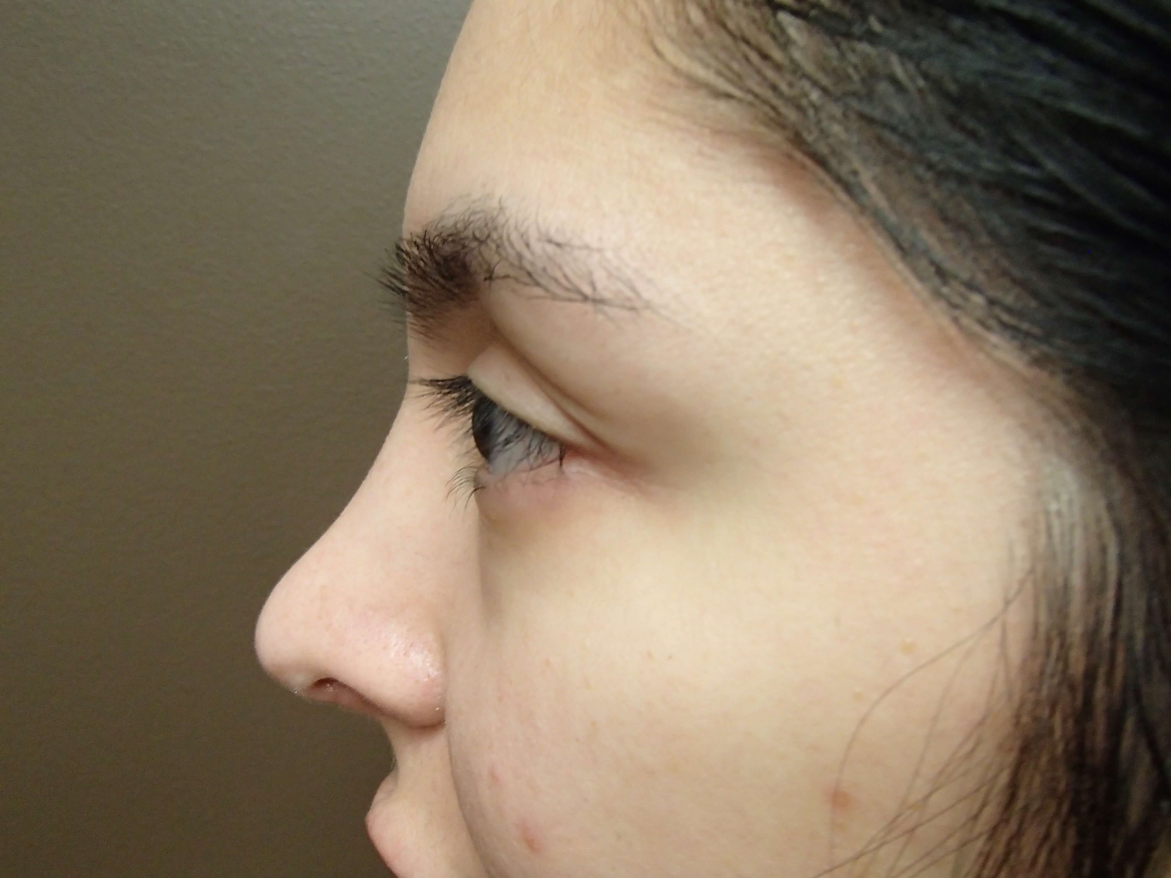 Rhinoplasty w/ Septoplasty After