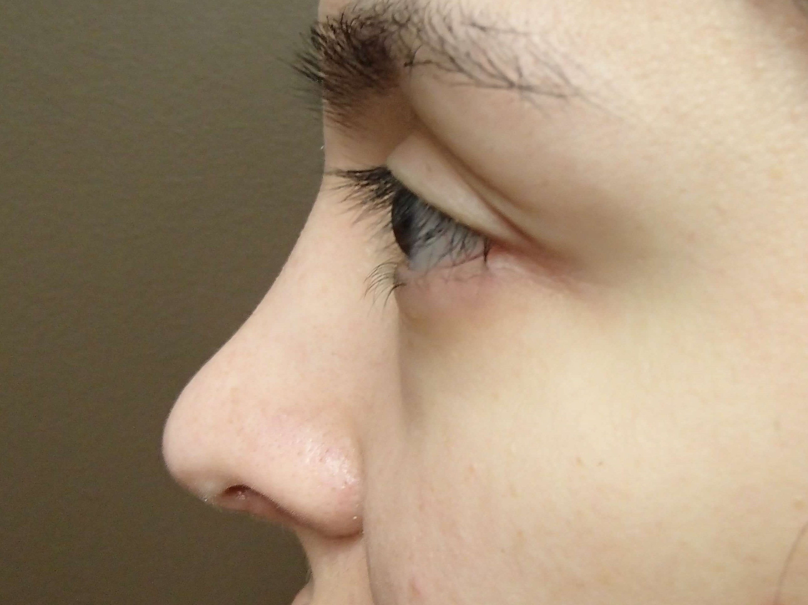 Rhinoplasty w/ Septoplasty After