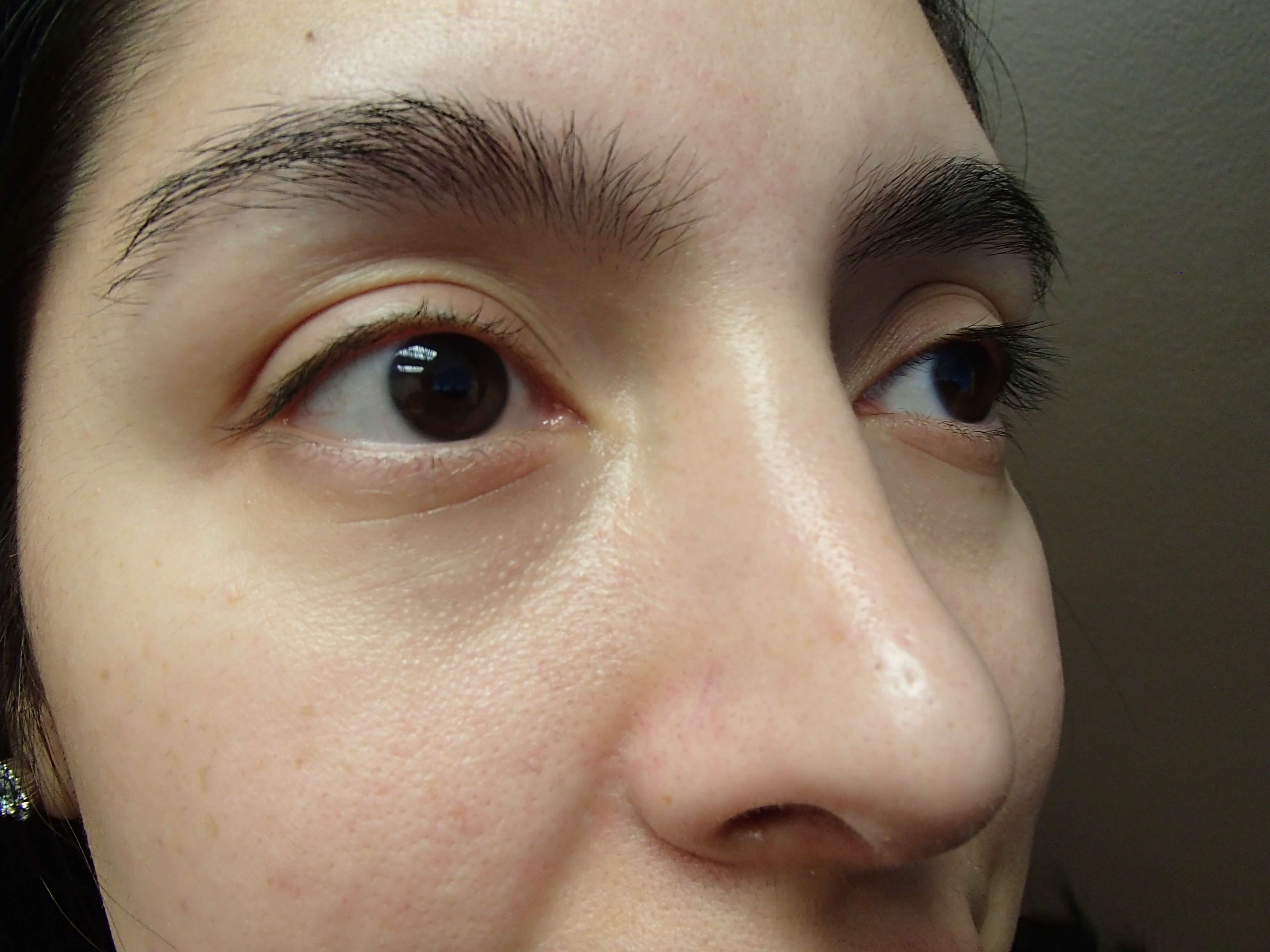 Rhinoplasty w/ Septoplasty After