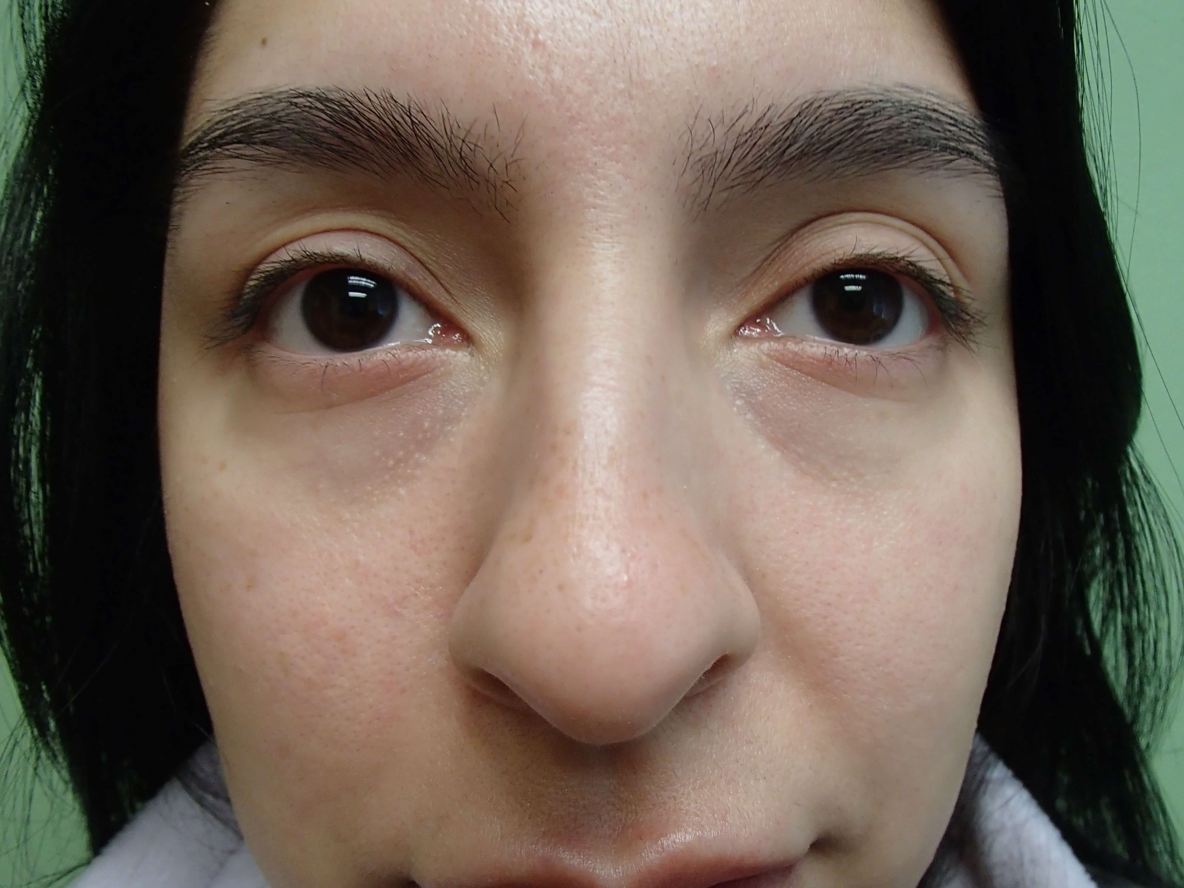 Rhinoplasty w/ Septoplasty Before