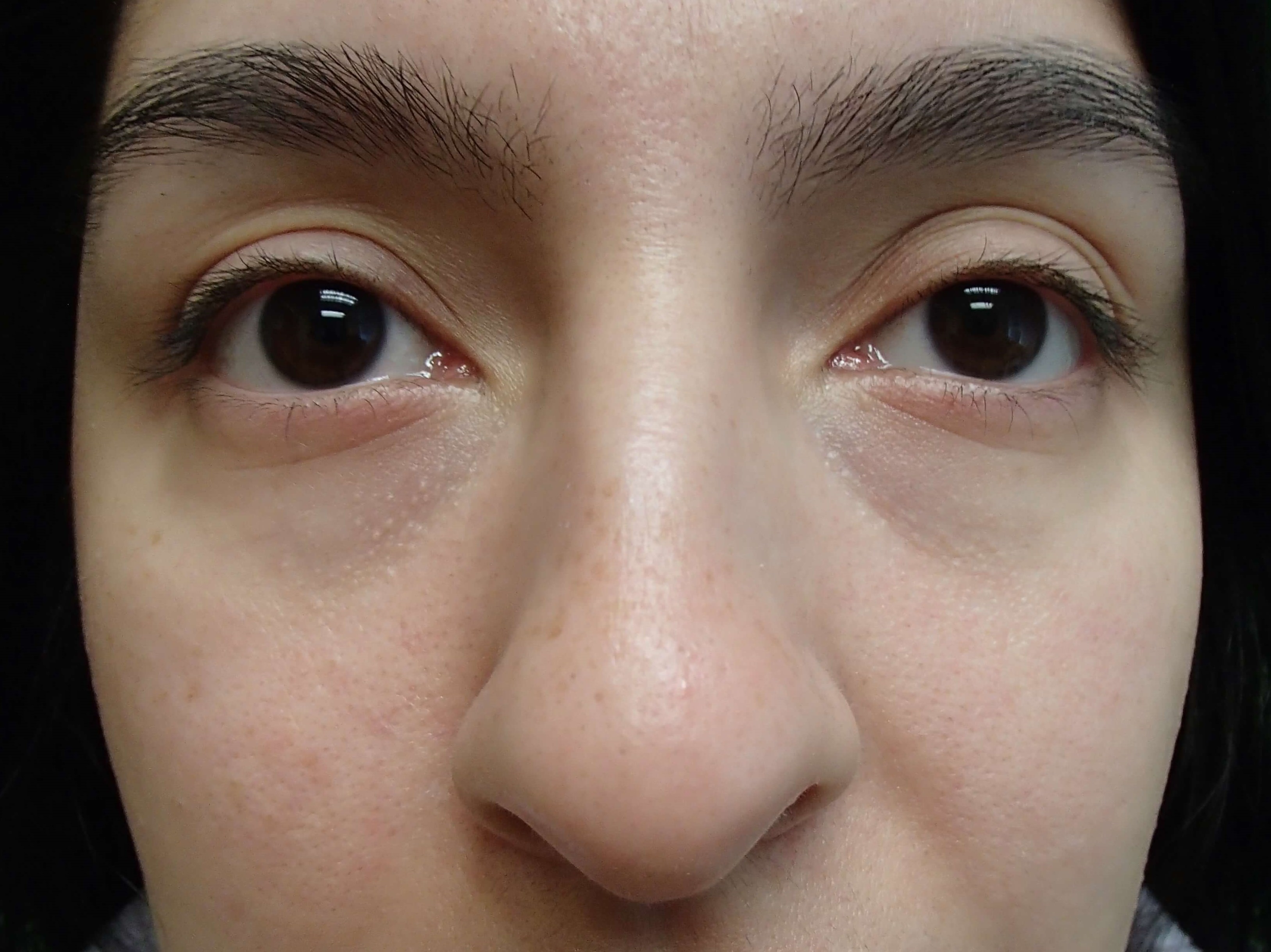 Rhinoplasty w/ Septoplasty Before