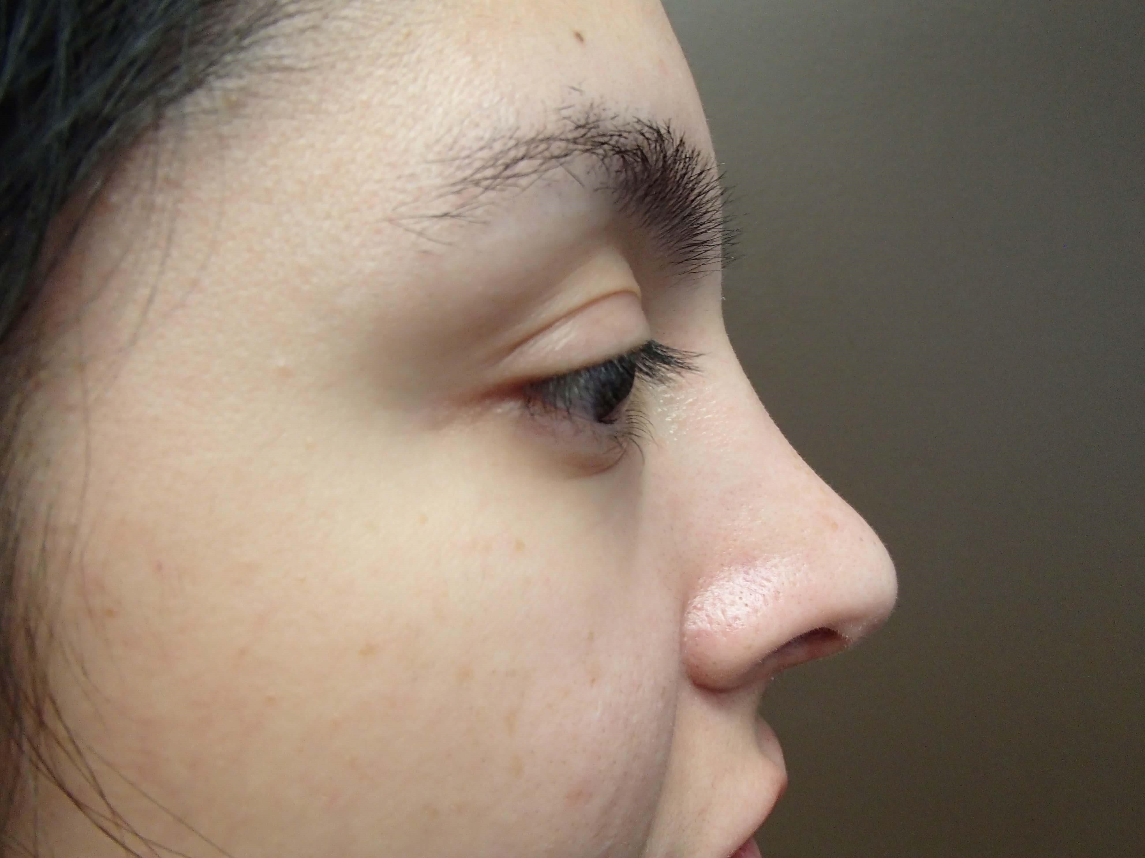 Rhinoplasty w/ Septoplasty After