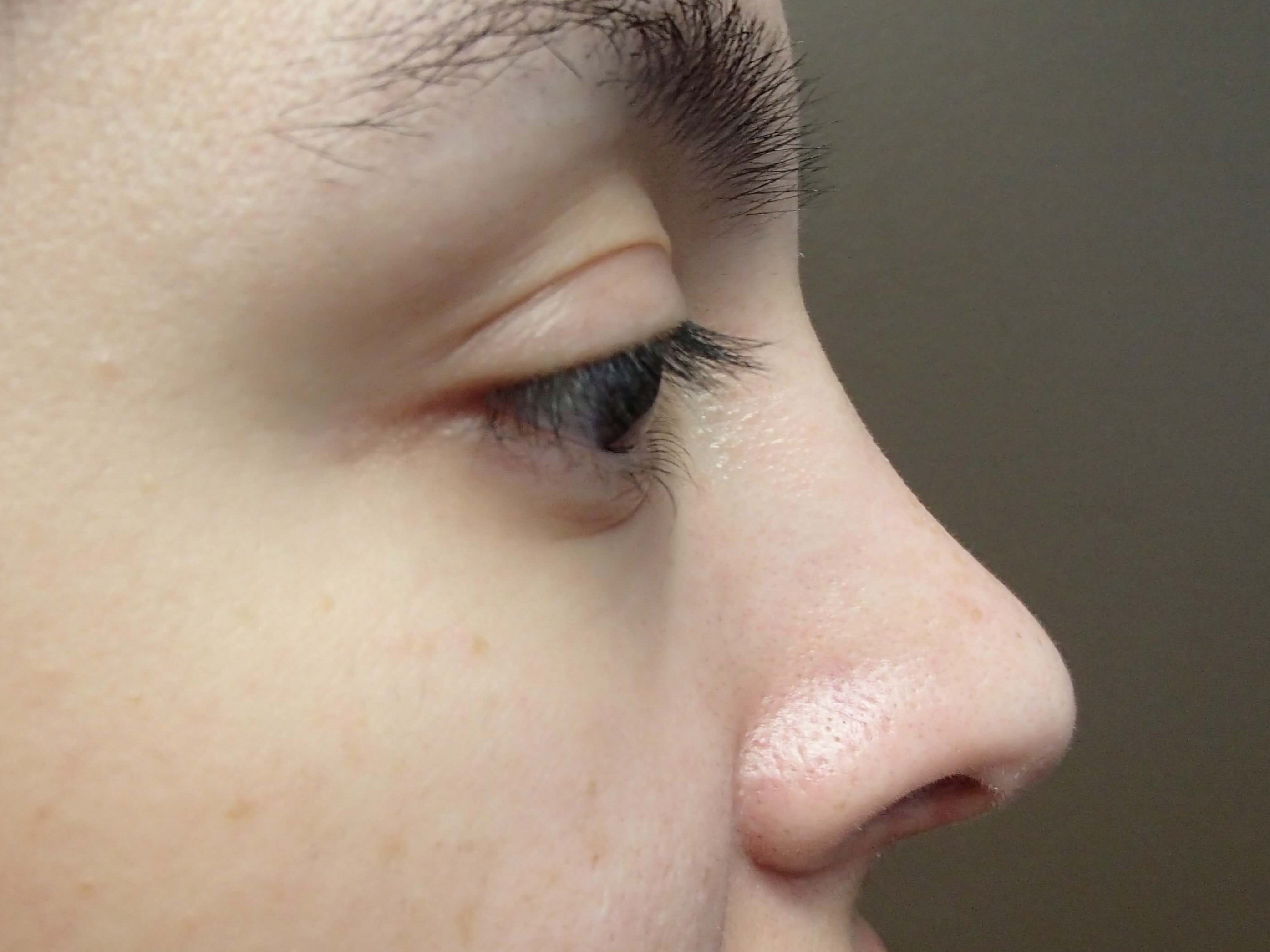Rhinoplasty w/ Septoplasty After