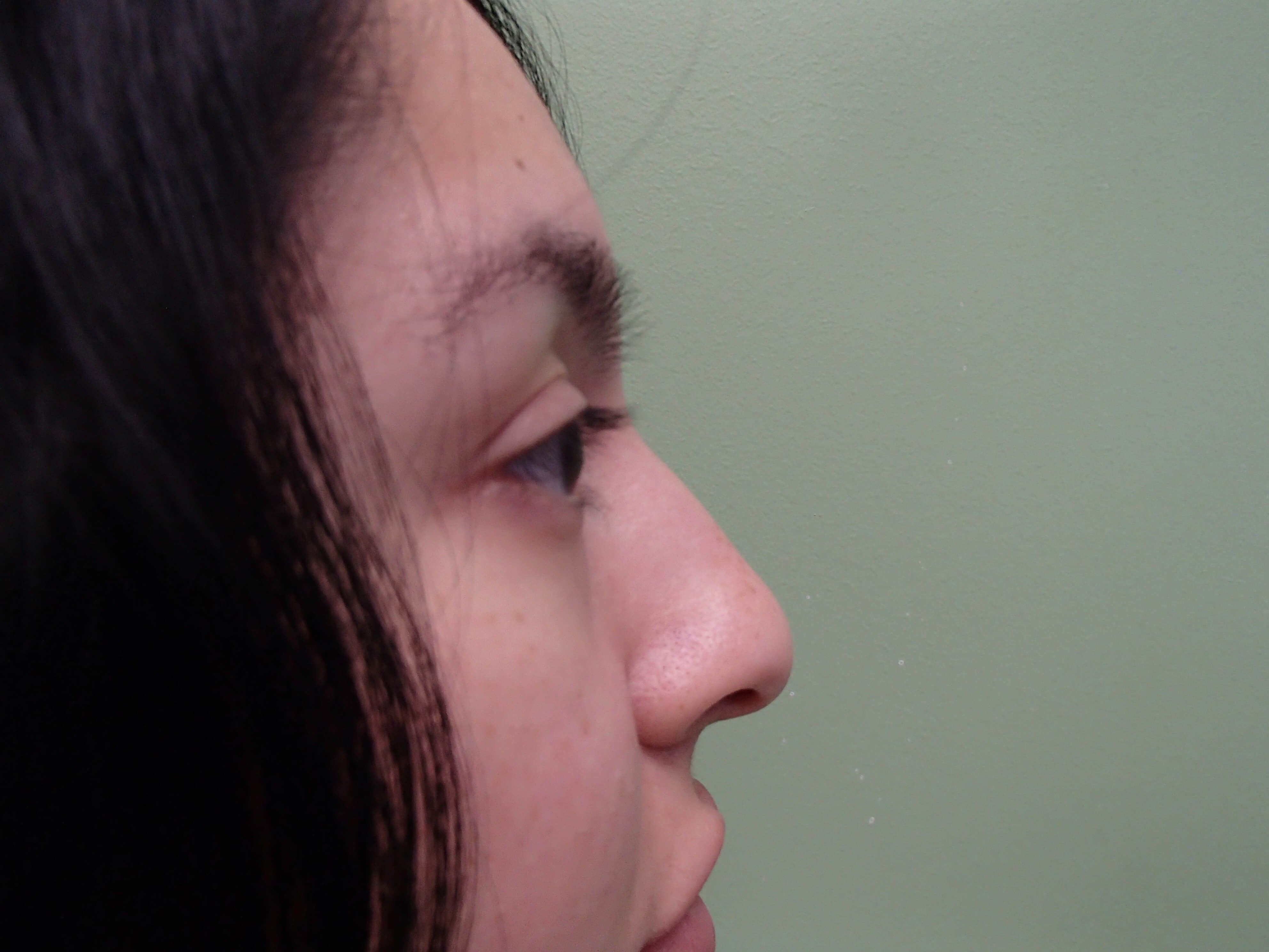 Rhinoplasty w/ Septoplasty Before
