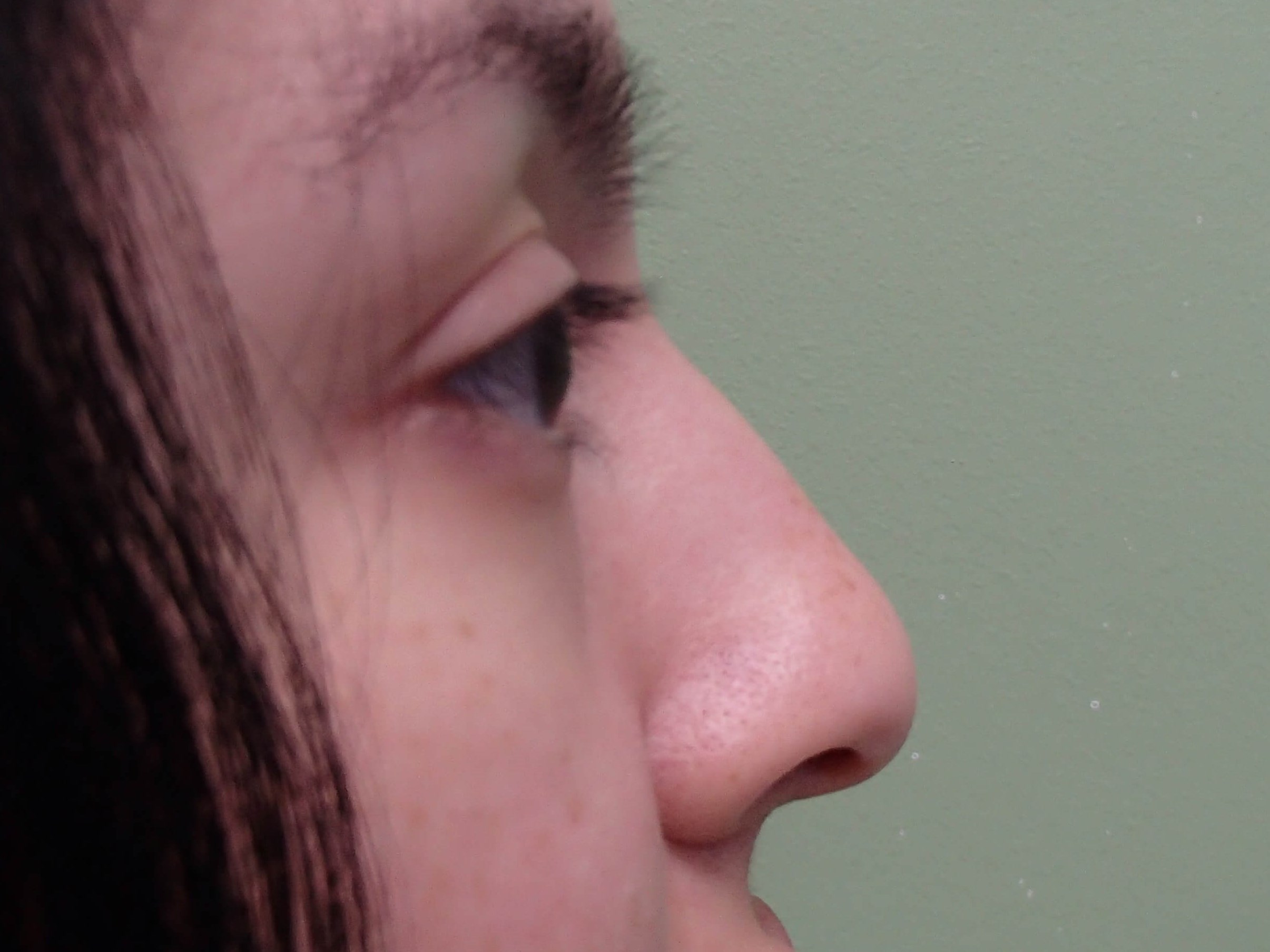 Rhinoplasty w/ Septoplasty Before